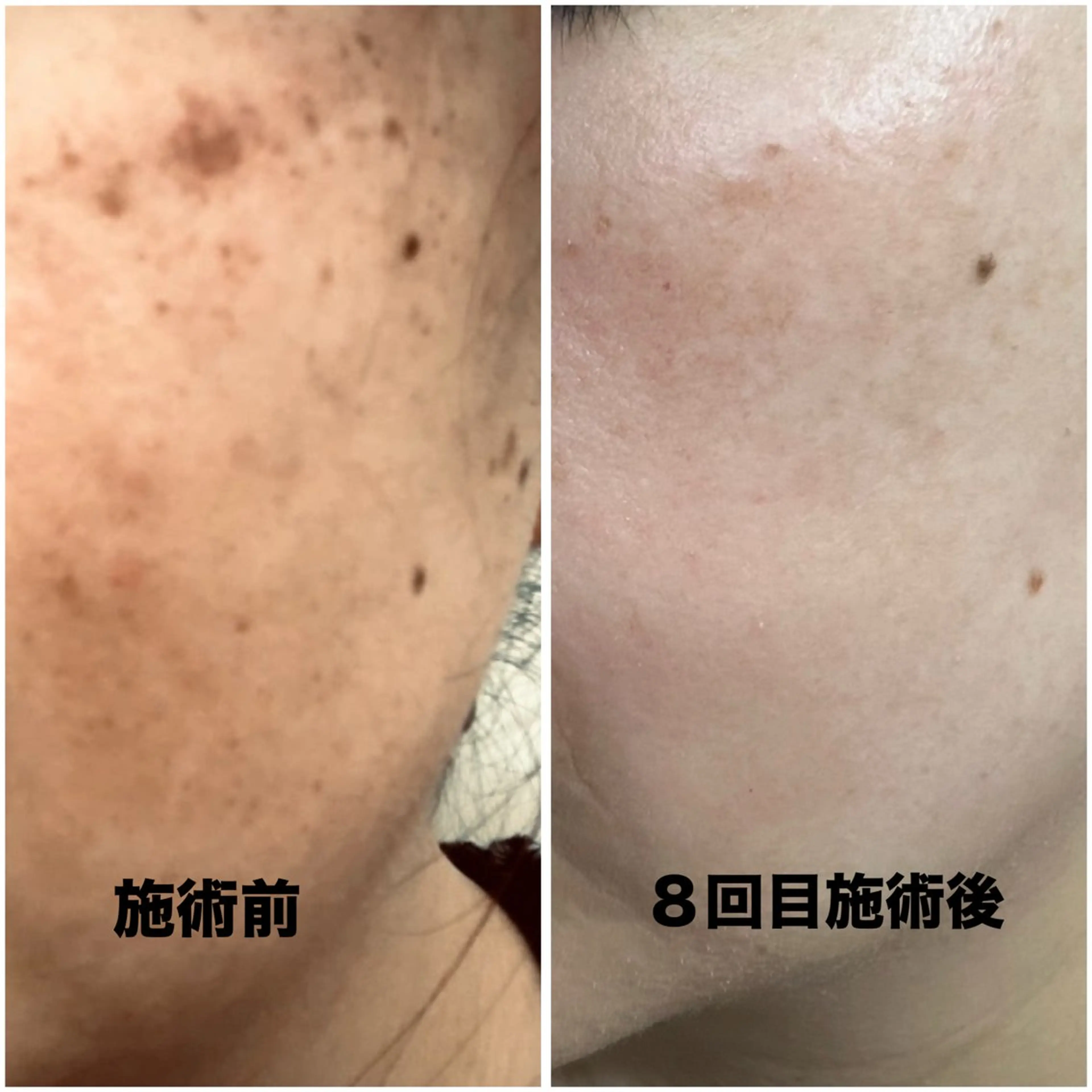 【短期集中】美肌ケア（月2回）※１回あたり9000円の写真