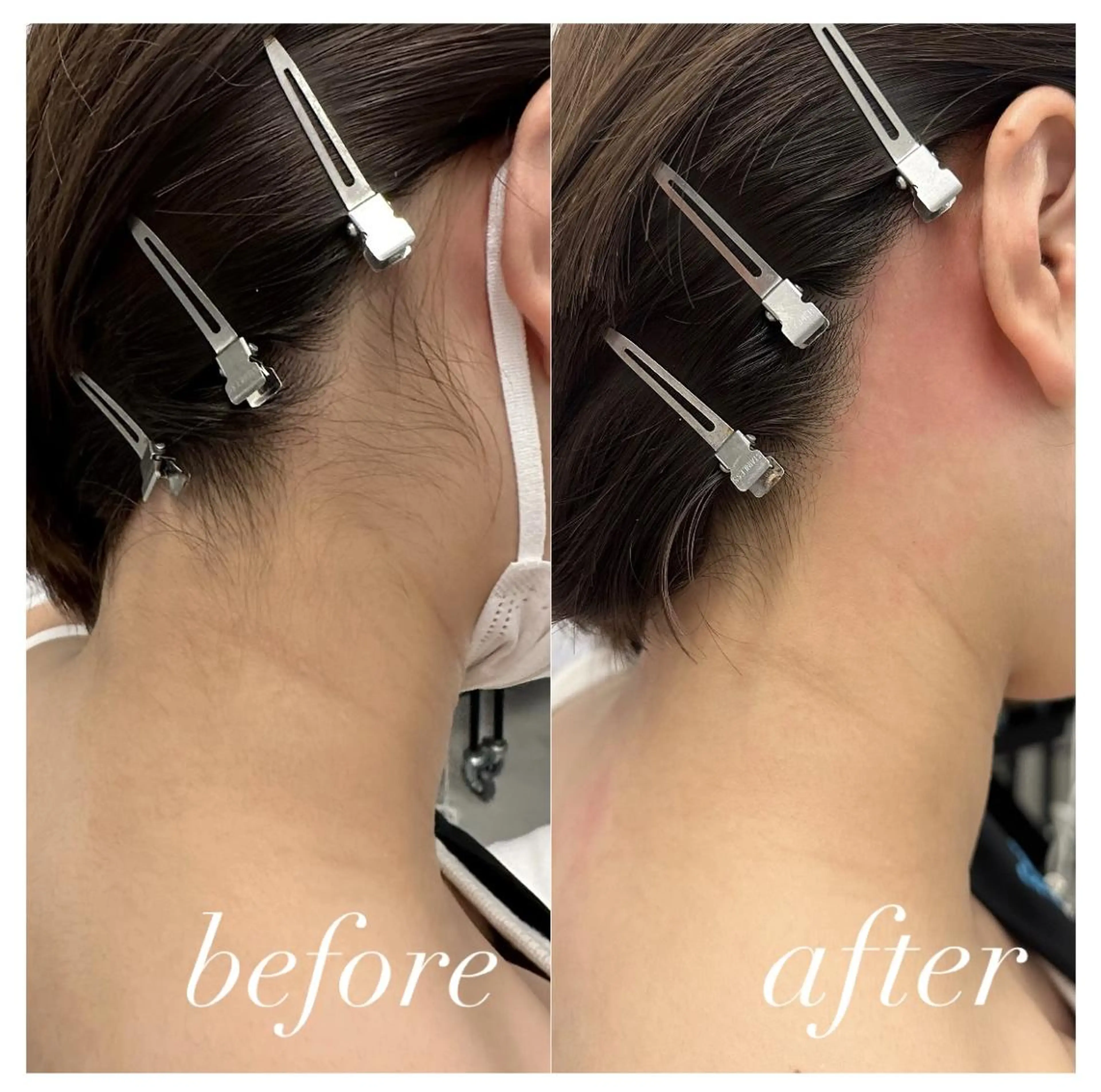 【うなじワックス脱毛】🤍ྀི角質も一緒にケアしてツルスベ肌に✨トーンアップ効果🫧の写真