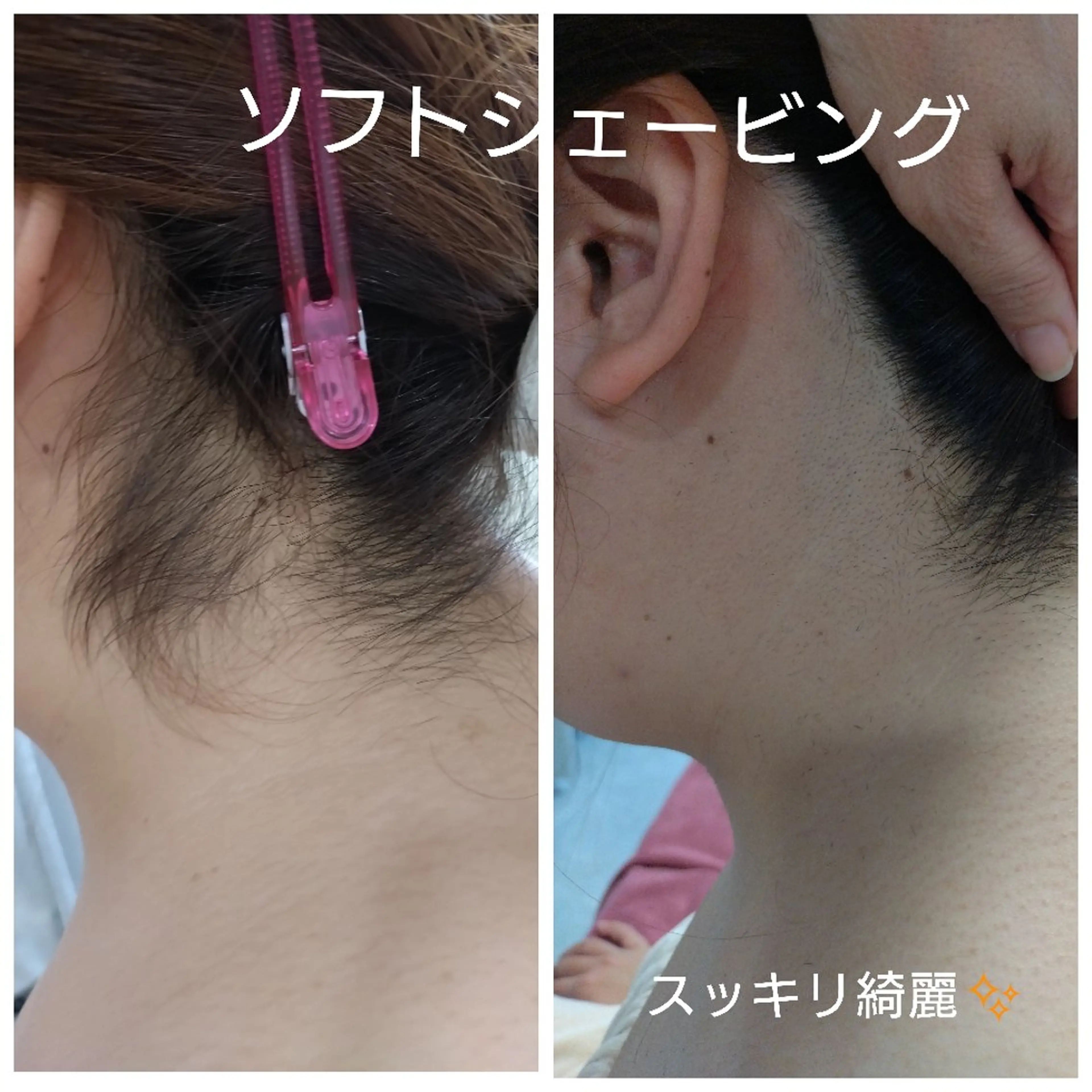 ブライダル✨ソフトシェービング◇背中・うなじの写真