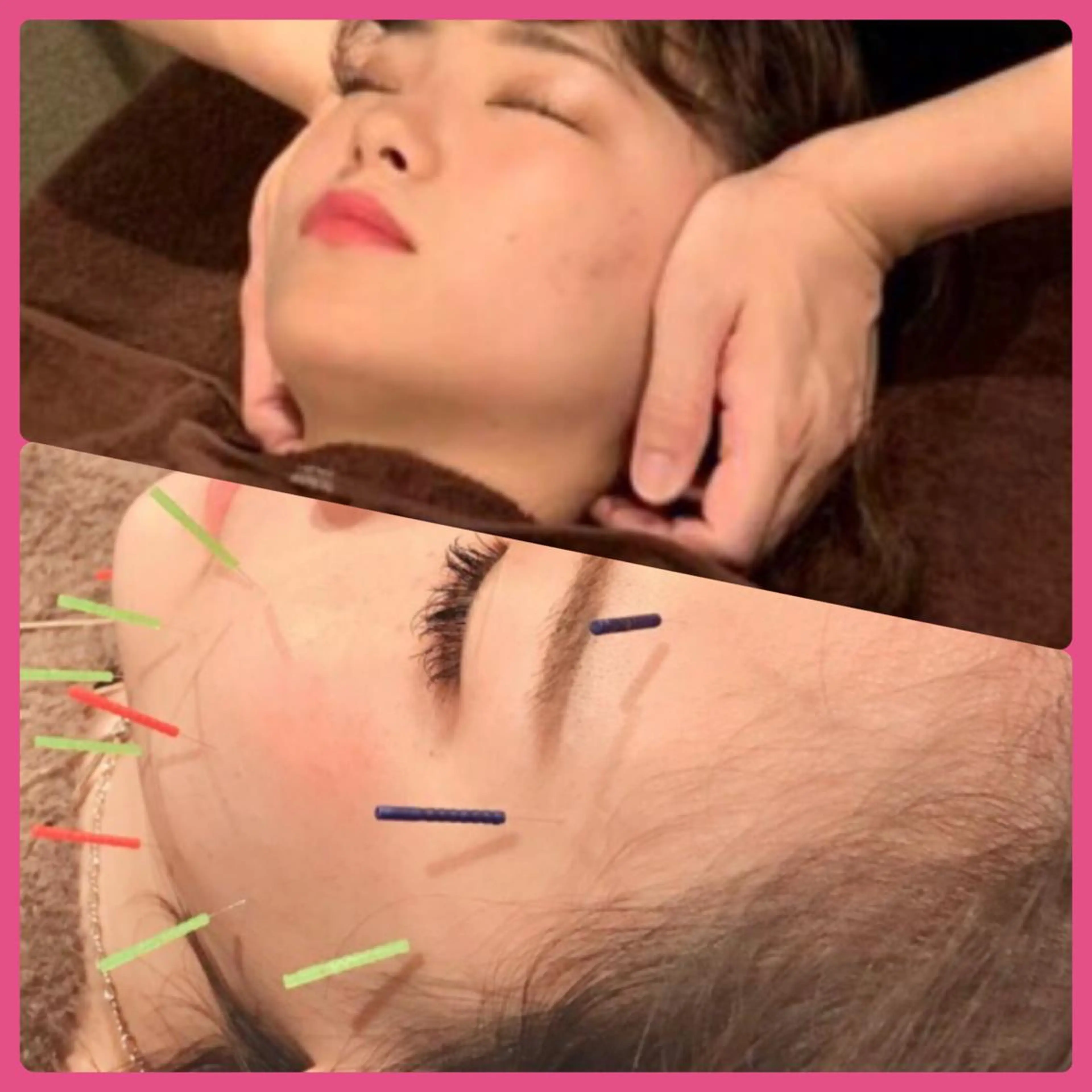 美容鍼➕小顔施術⭐️鍼＋小顔の同時施術により相乗効果↑ 【ご新規様限定】の写真