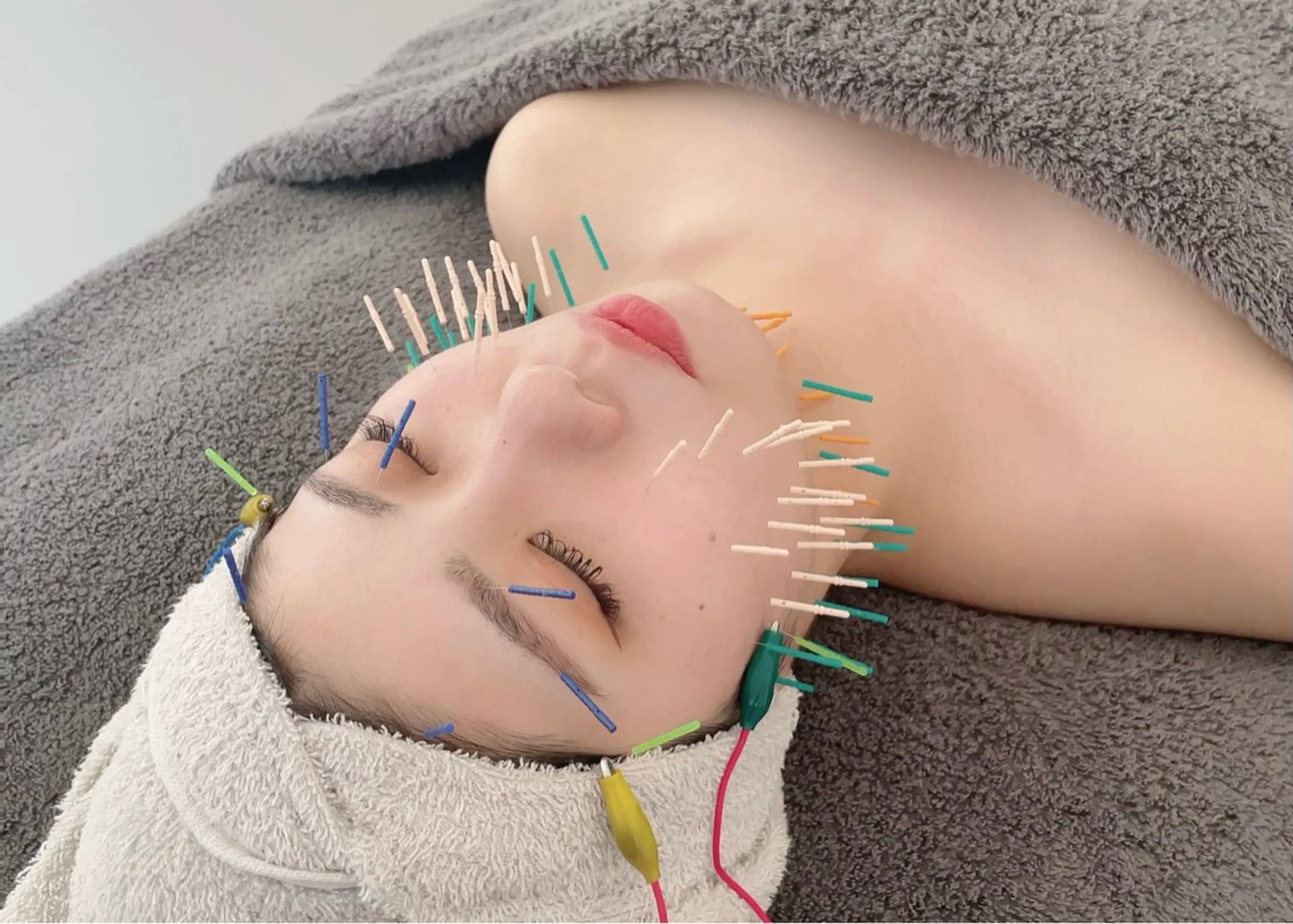 【限定価格💕】100本美容鍼5,900円(税込)の写真