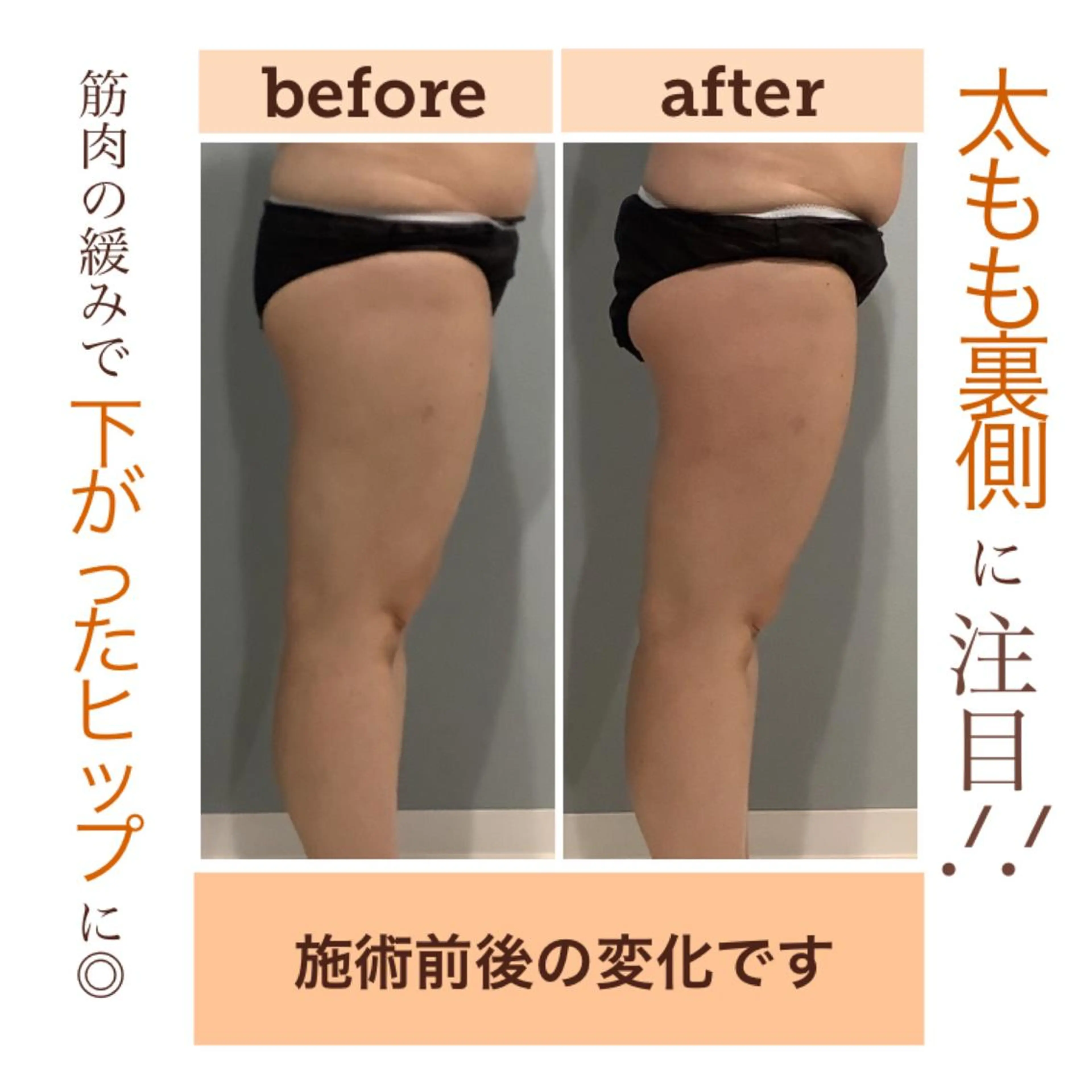 ヒップアップ #ダイエット #キャビテーション #ラジオ波 #吸引 #EMS