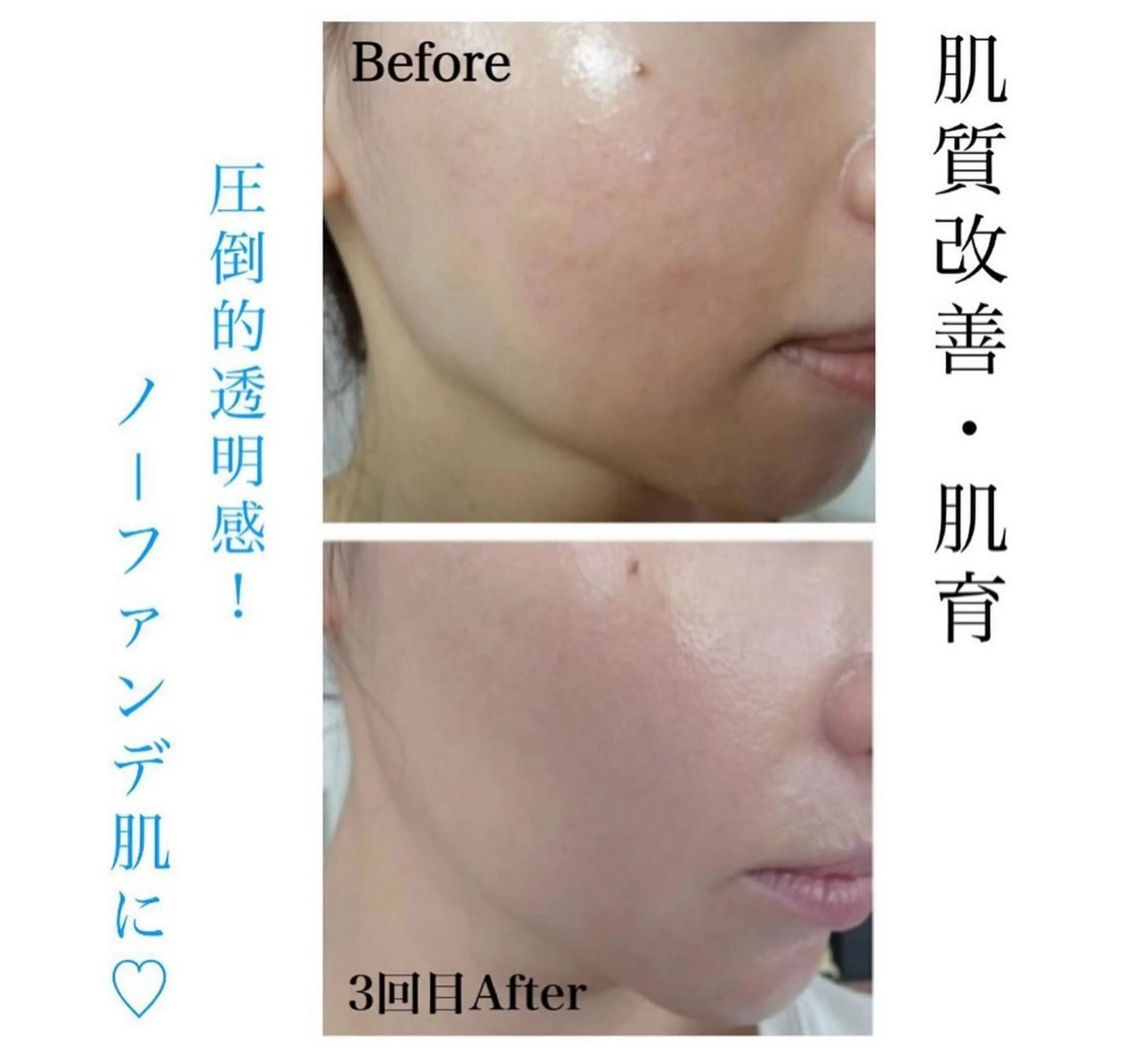 ダウンタイムのないハーブピーリング🌿プラチナクレイピールの写真