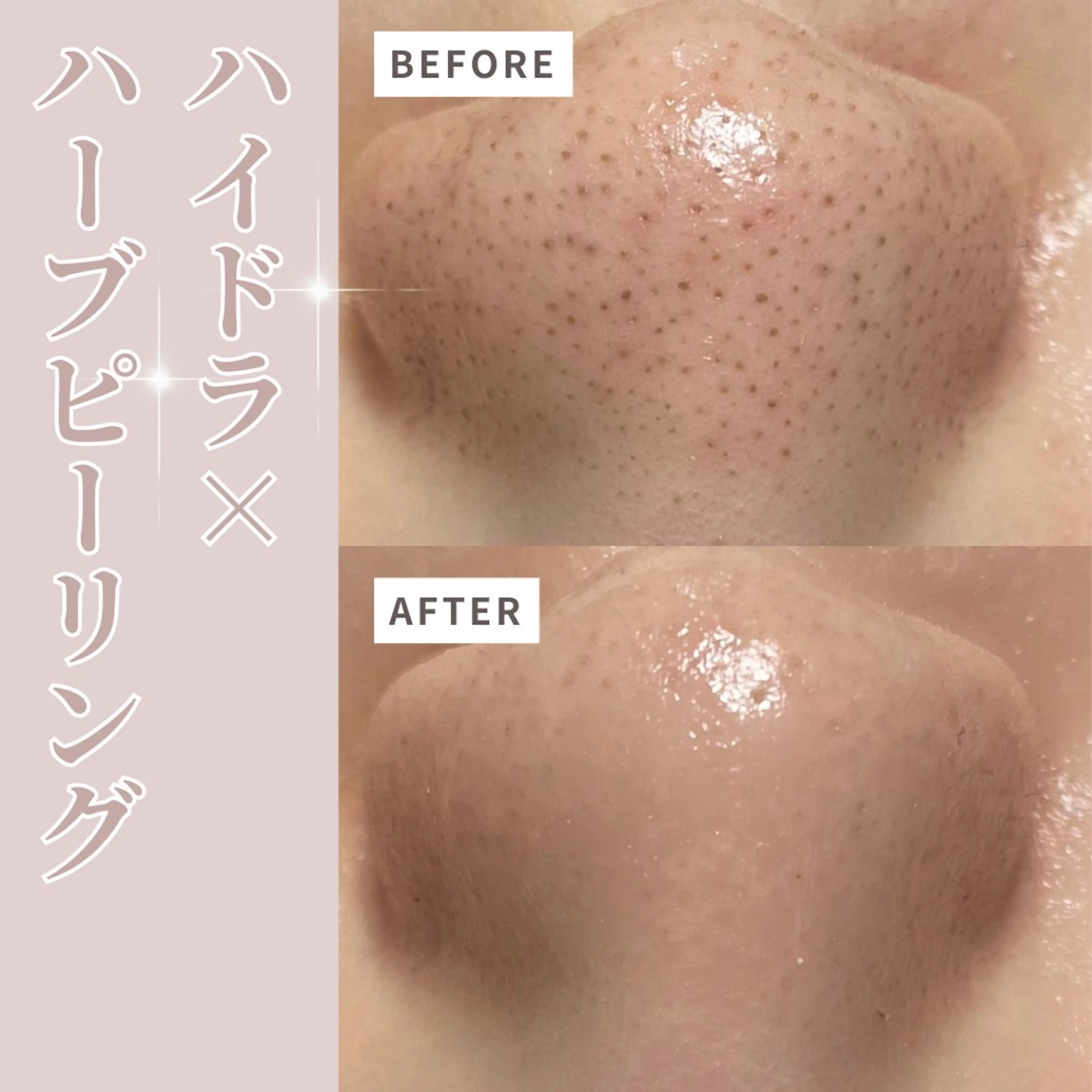 【角栓徹底除去❤️】水素ハイドラフェイシャルフルコース💆🏼‍♀️の写真