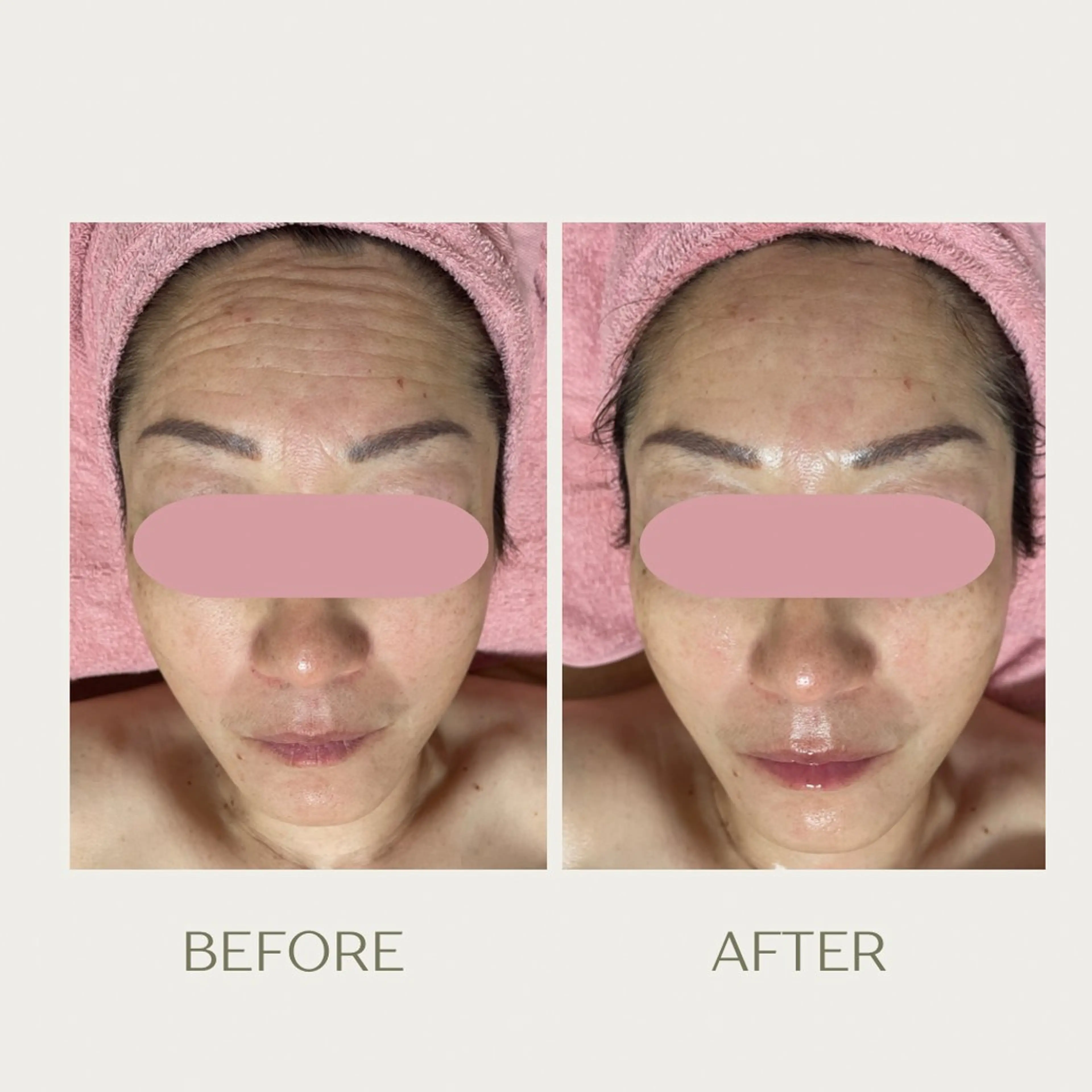 エステ ピーリングケア 🤍moekoのエステ・リラクイメージ