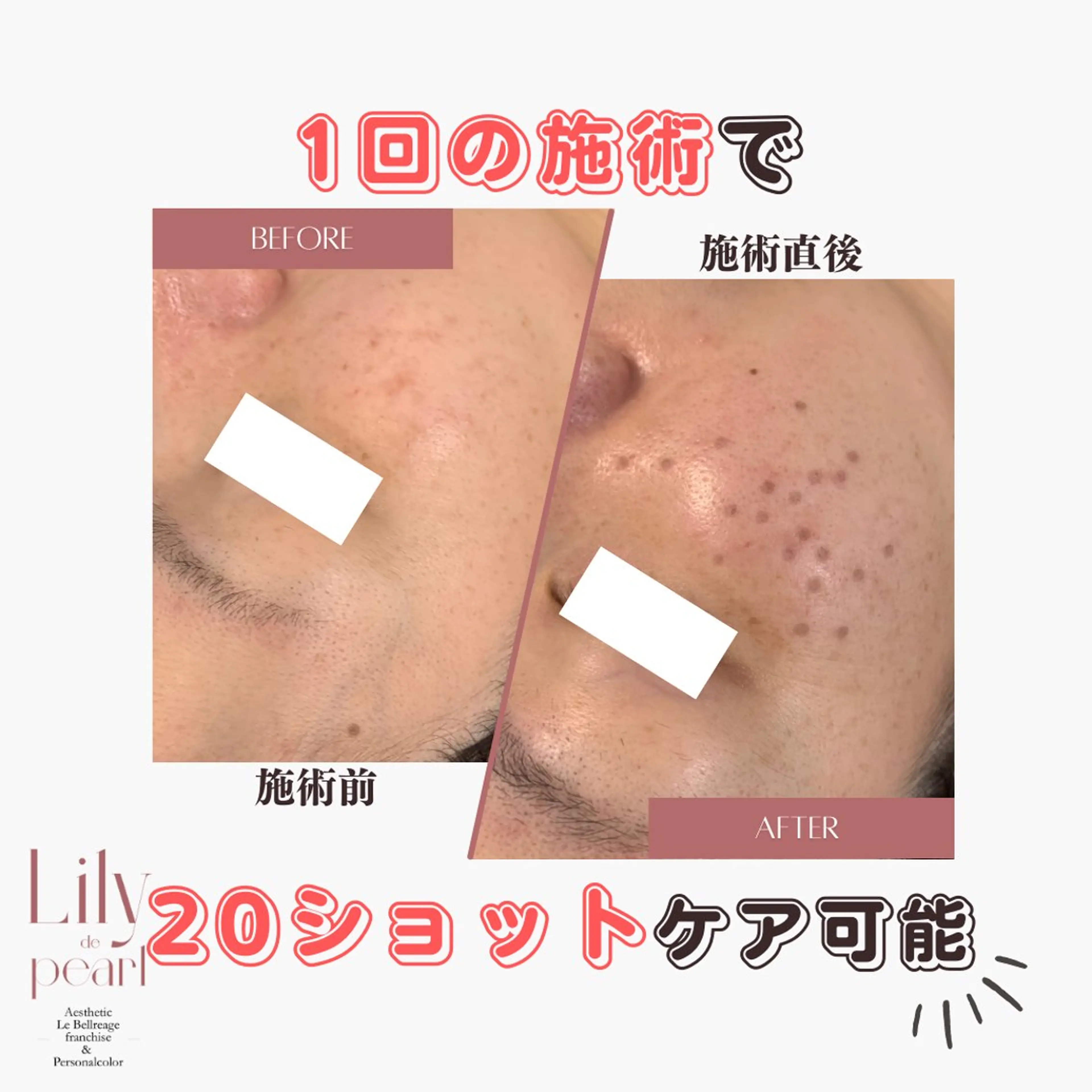 エステ 最新シミケアLily de pearlのエステ・リラクイメージ