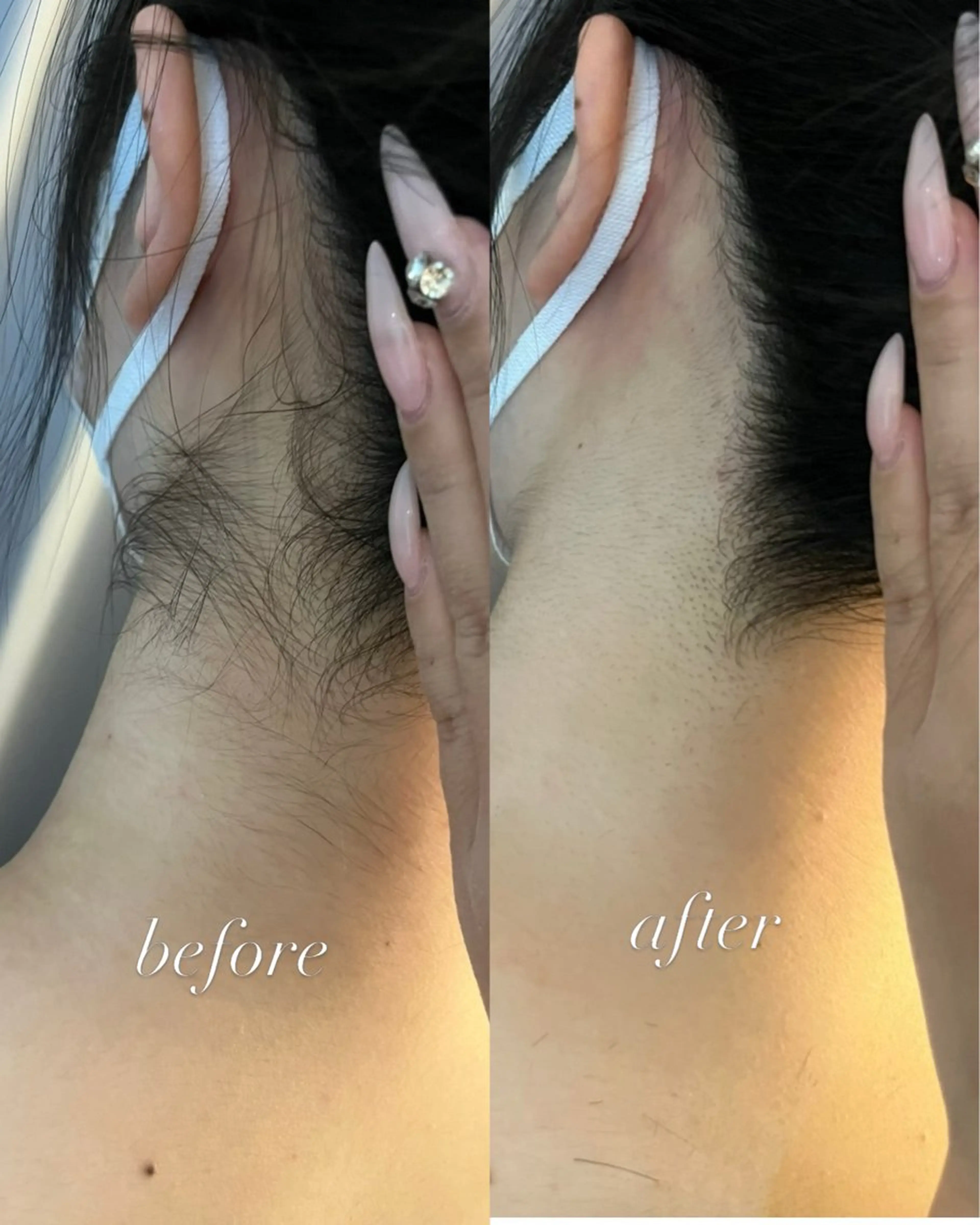 脱毛 うなじ脱毛/美肌脱毛 LABELのエステ・リラクイメージ