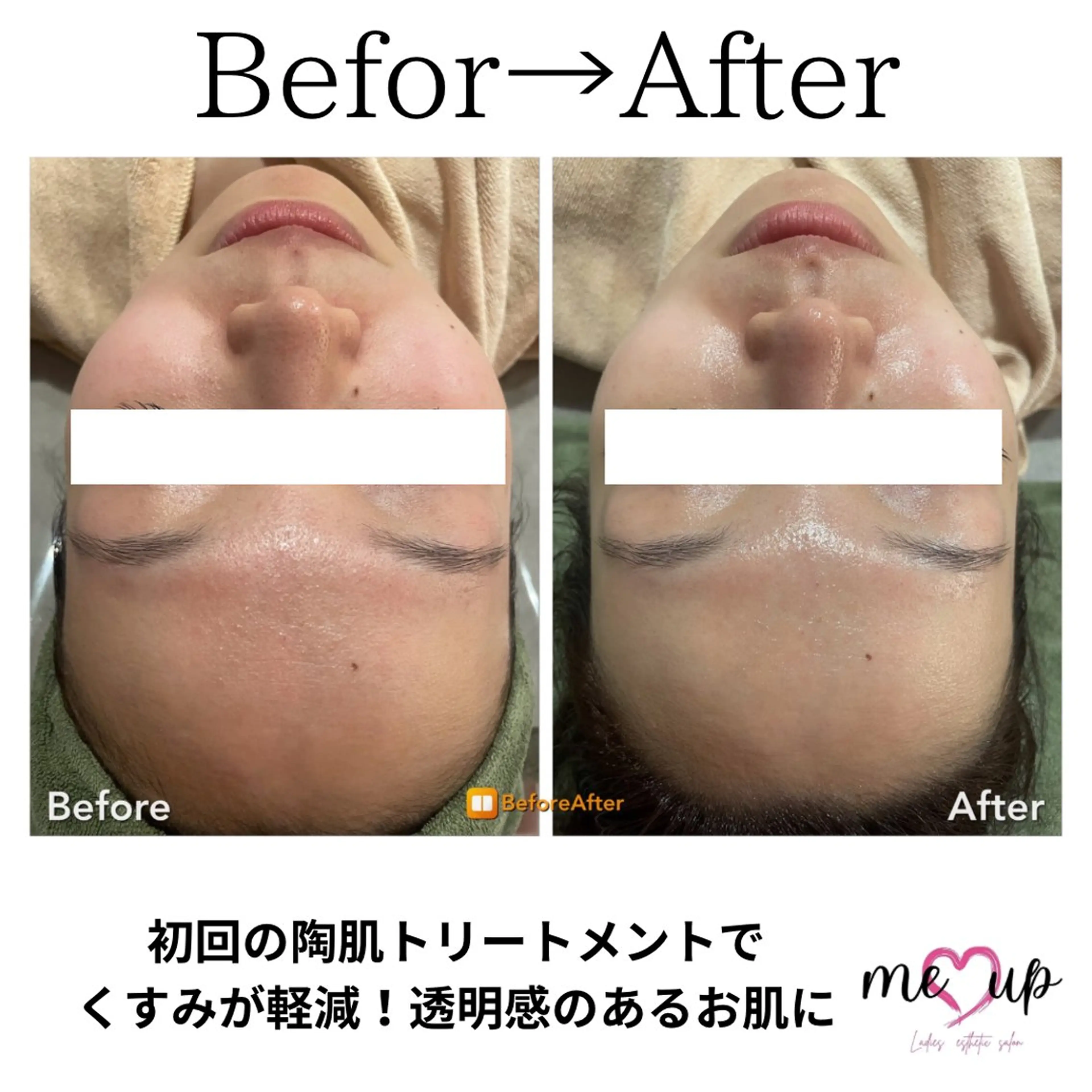 エステ Meupニキビ専門店 背中/ハーブ/肌管理のその他イメージ