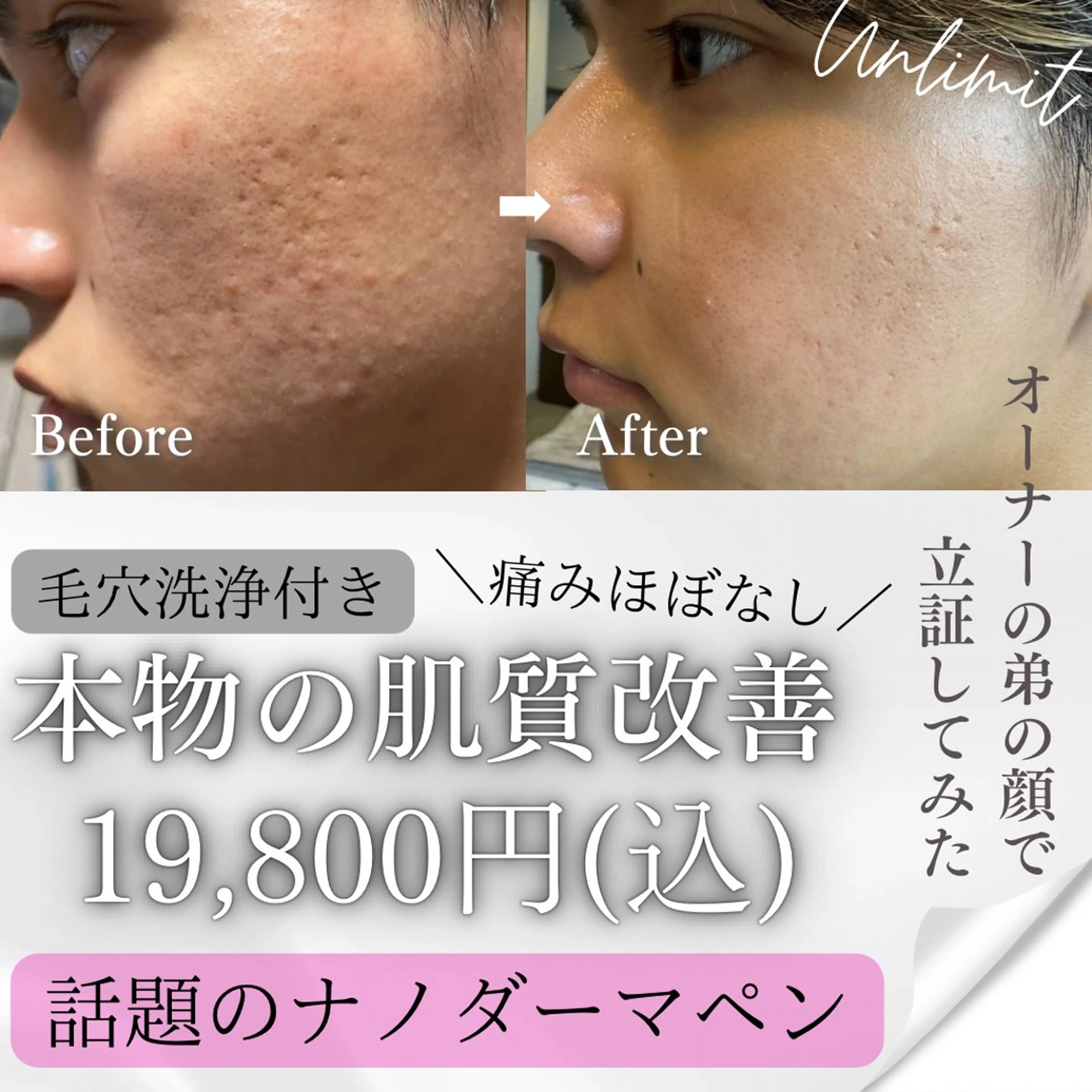 【毛穴.凸凹肌ケアに◎】肌質改善/毛穴洗浄×幹細胞エクソ導入× 微細針ナノダーマ 約60分の写真