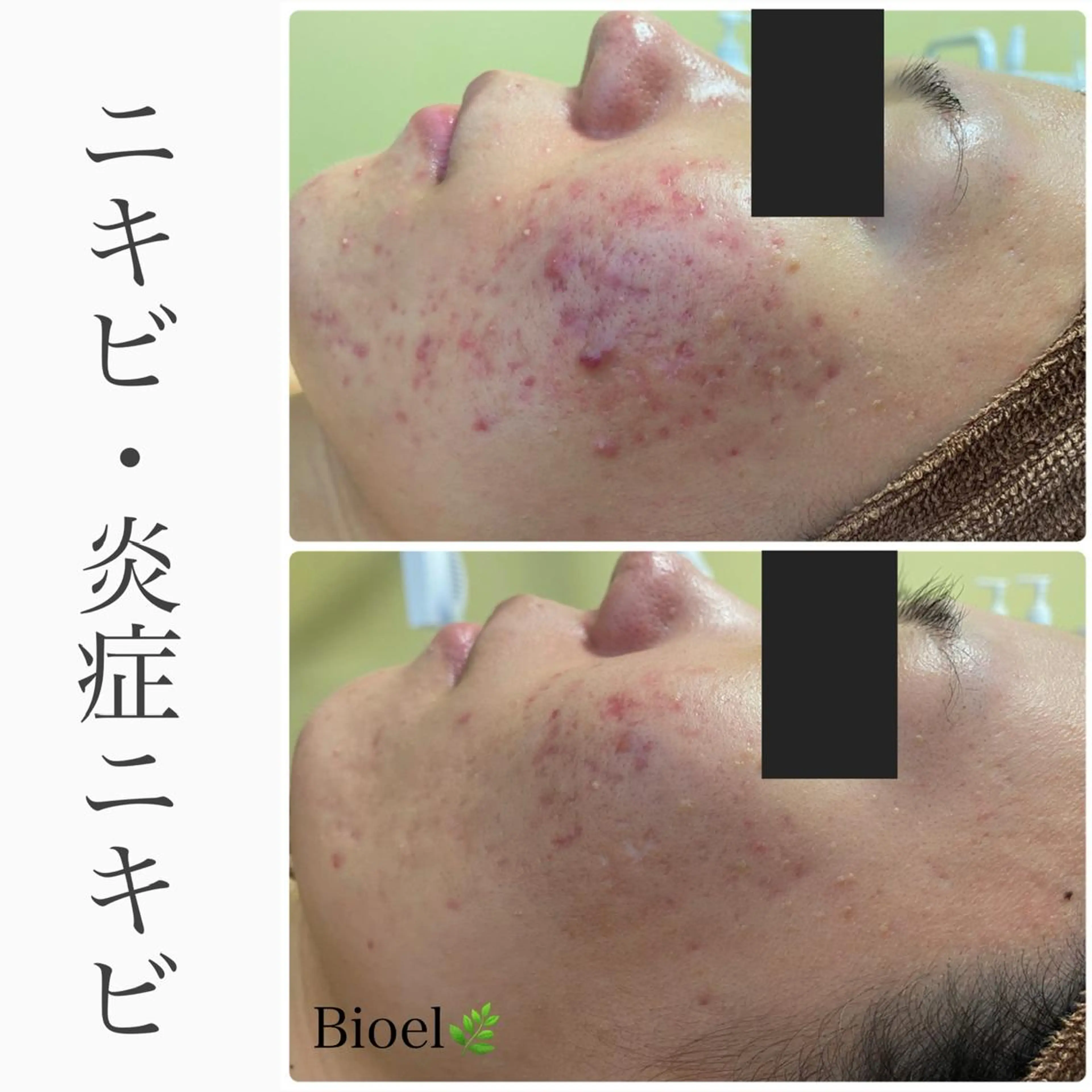 エステ BeSkin藤沢店所属・ニキビ/肌質改善 BeSkin 藤沢店のエステ・リラクイメージ