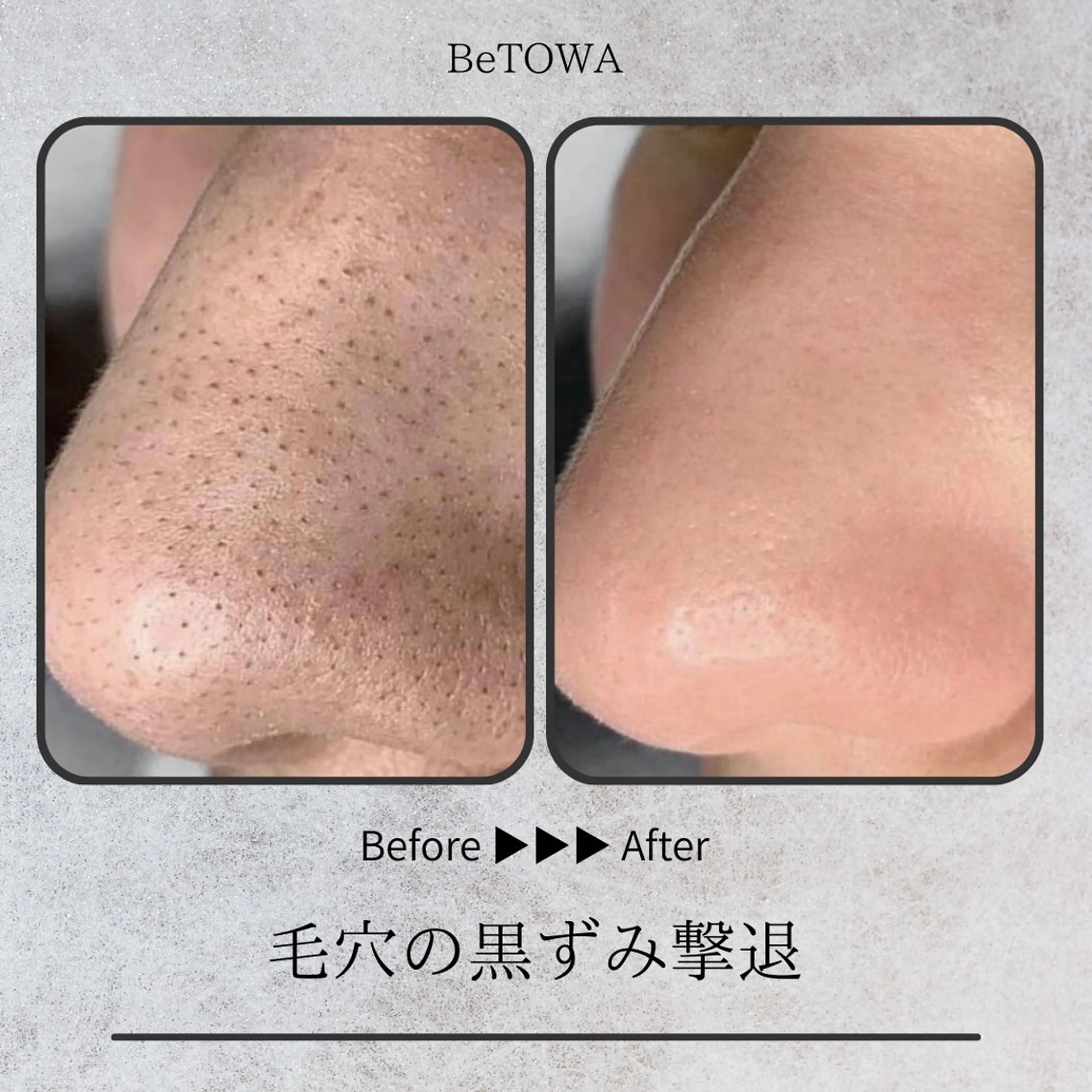 エステ BeTOWA所属・BeTOWA 毛穴洗浄／Wax脱毛のエステ・リラクイメージ