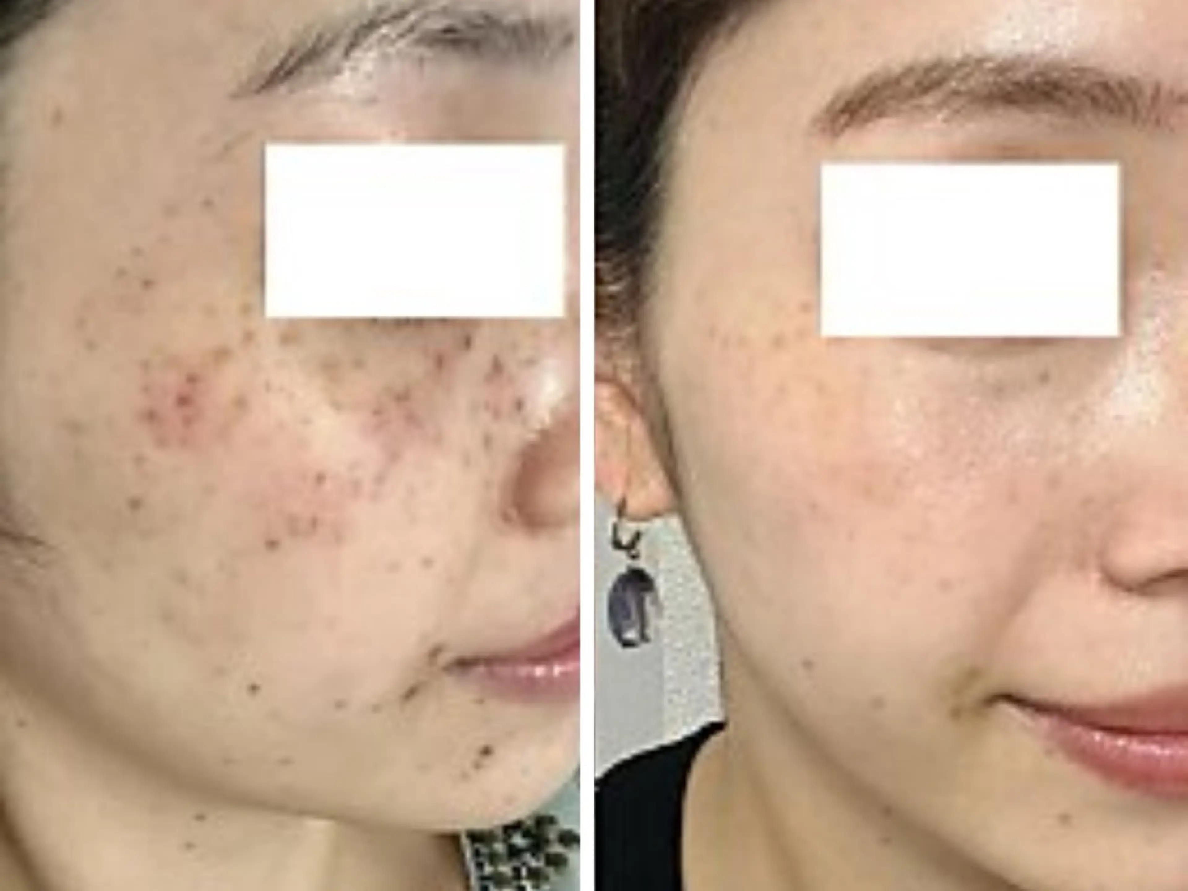 【1周年感謝祭　スペシャル企画】全顔シミ・毛穴ケア打ち放題✨の写真