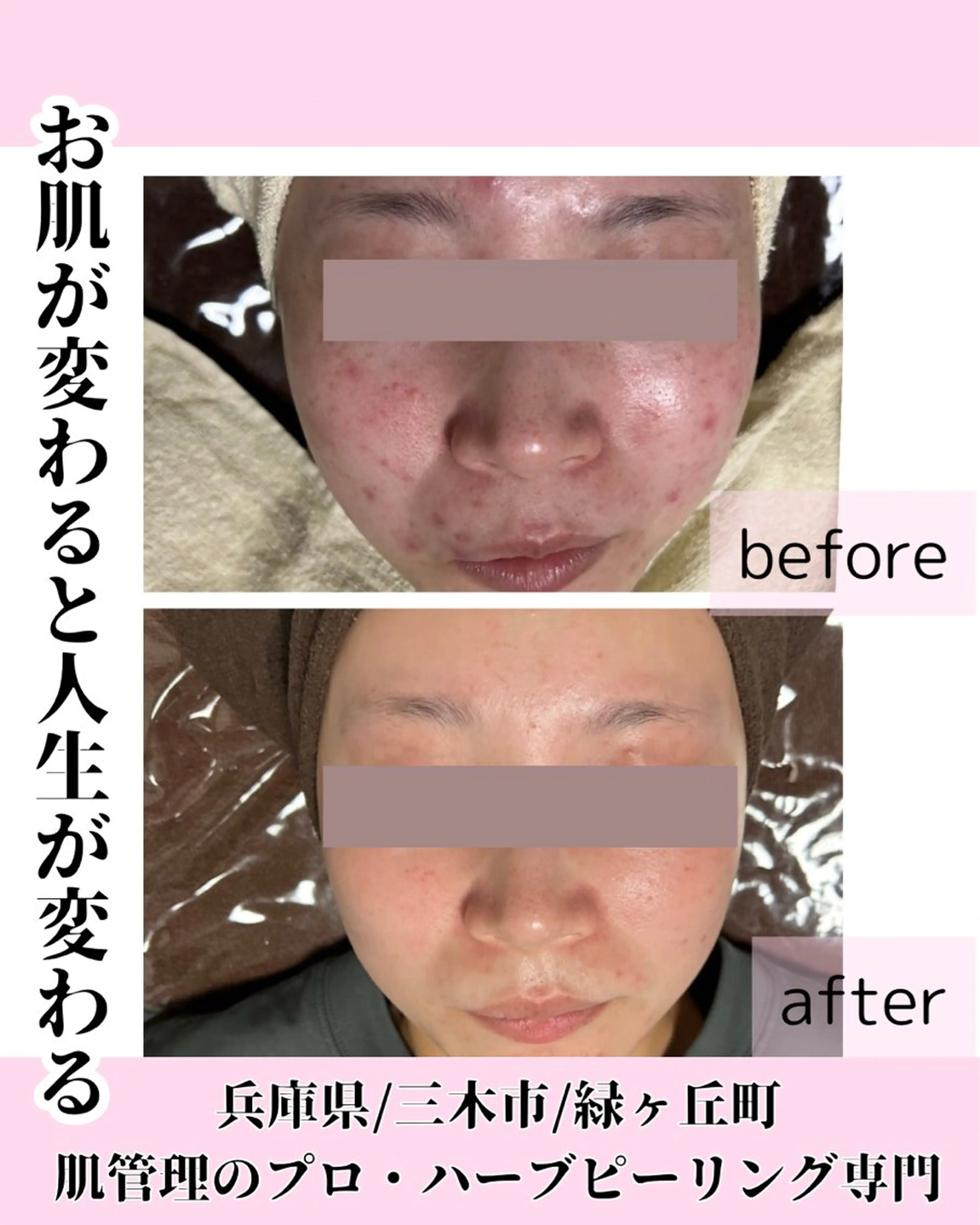 本気のハーブピーリング選べる(剥離あり、なし)肌質改善Ｎｏ．1の写真