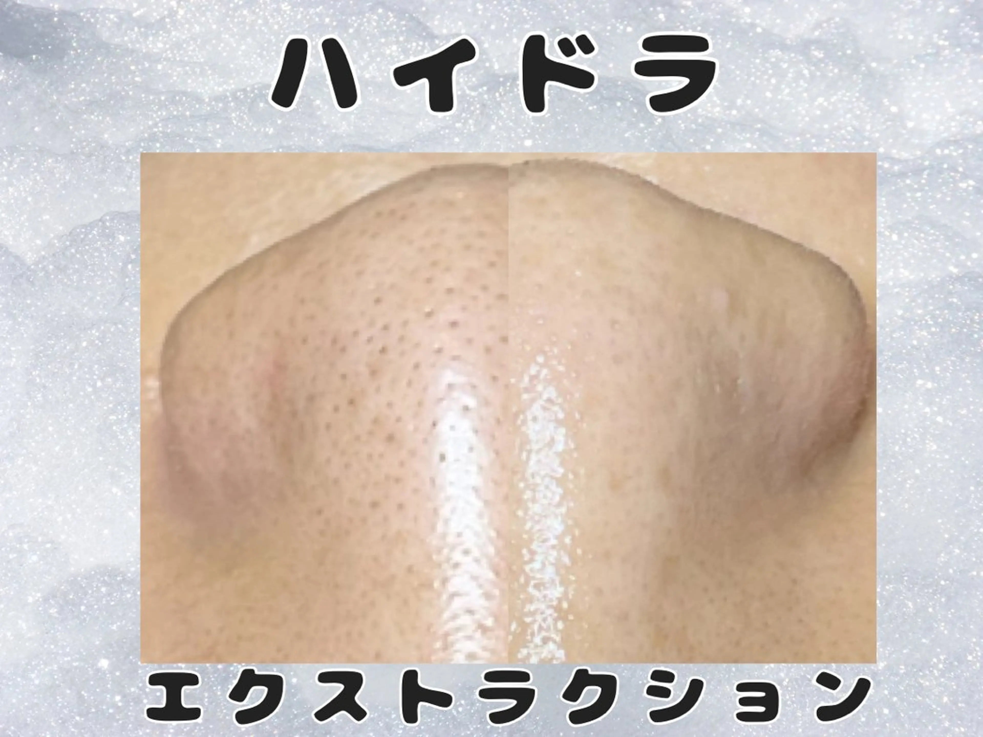 ハイドラ×毛穴エクストラクション★水光肌リフティング付きの写真