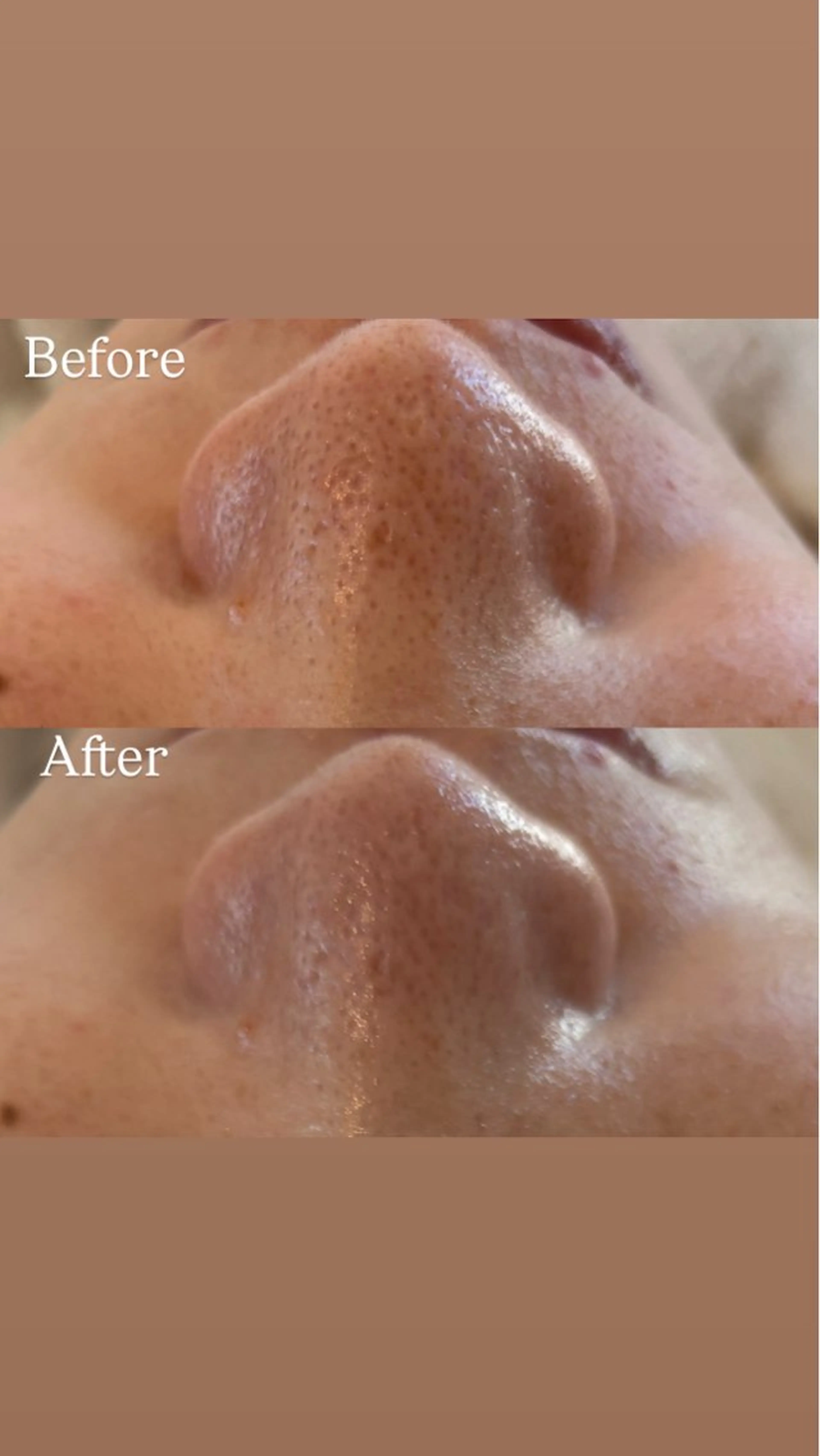 【人気menu♡】毛穴&くすみ改善コースの写真