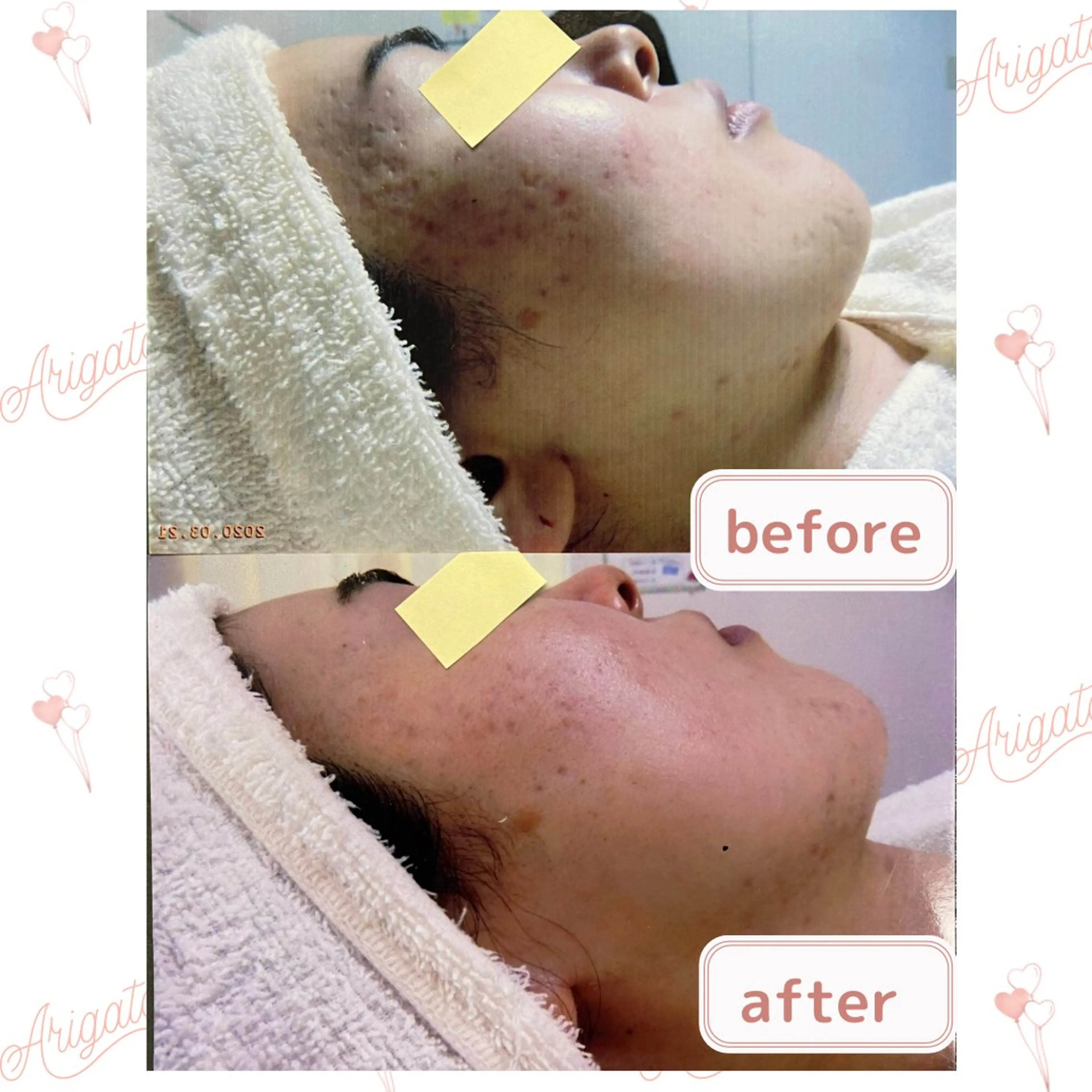 ニキビケア◇ニキビ跡 レゾン京橋店　八崎のエステ・リラクイメージ