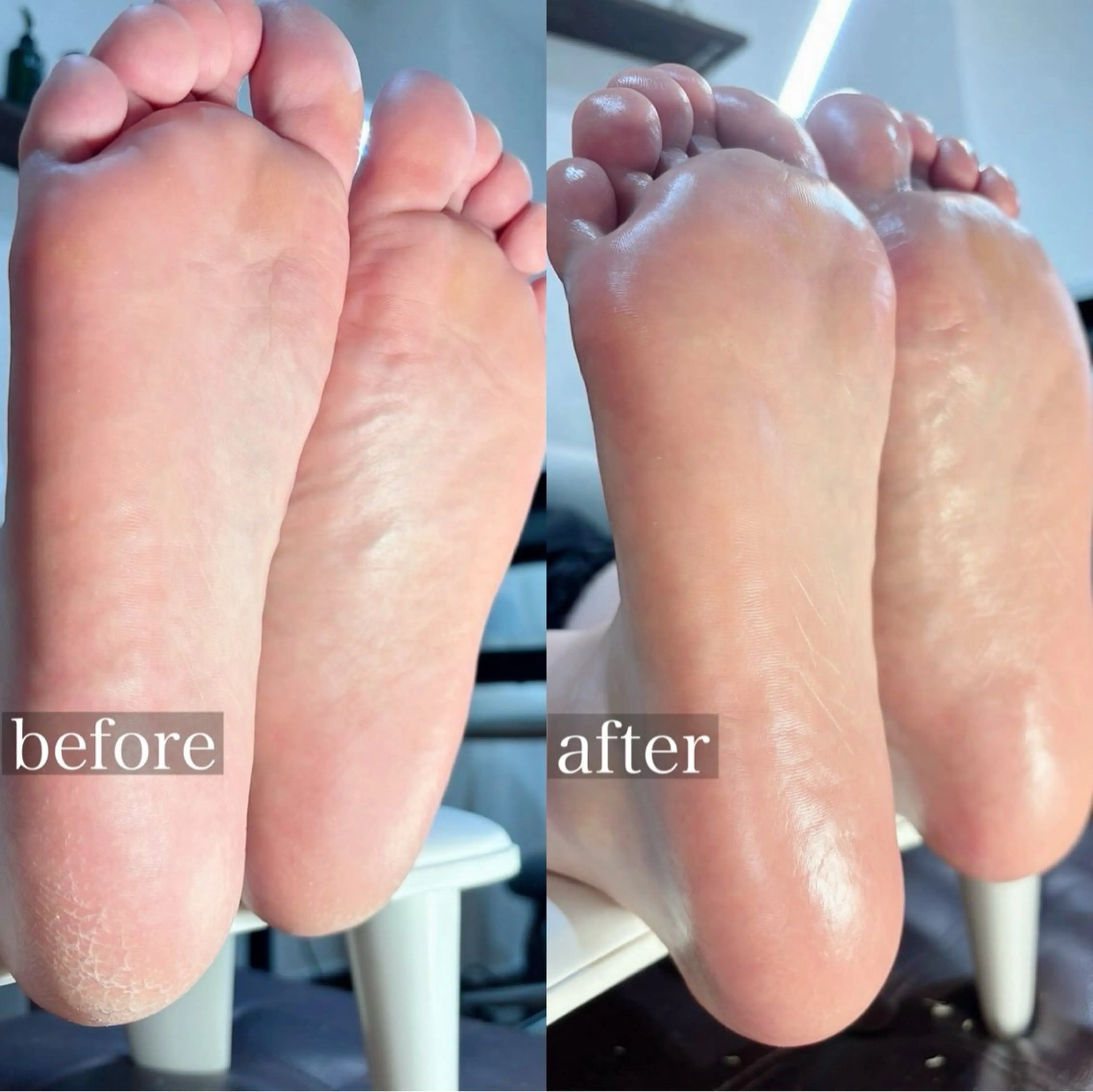 角質ケアの写真