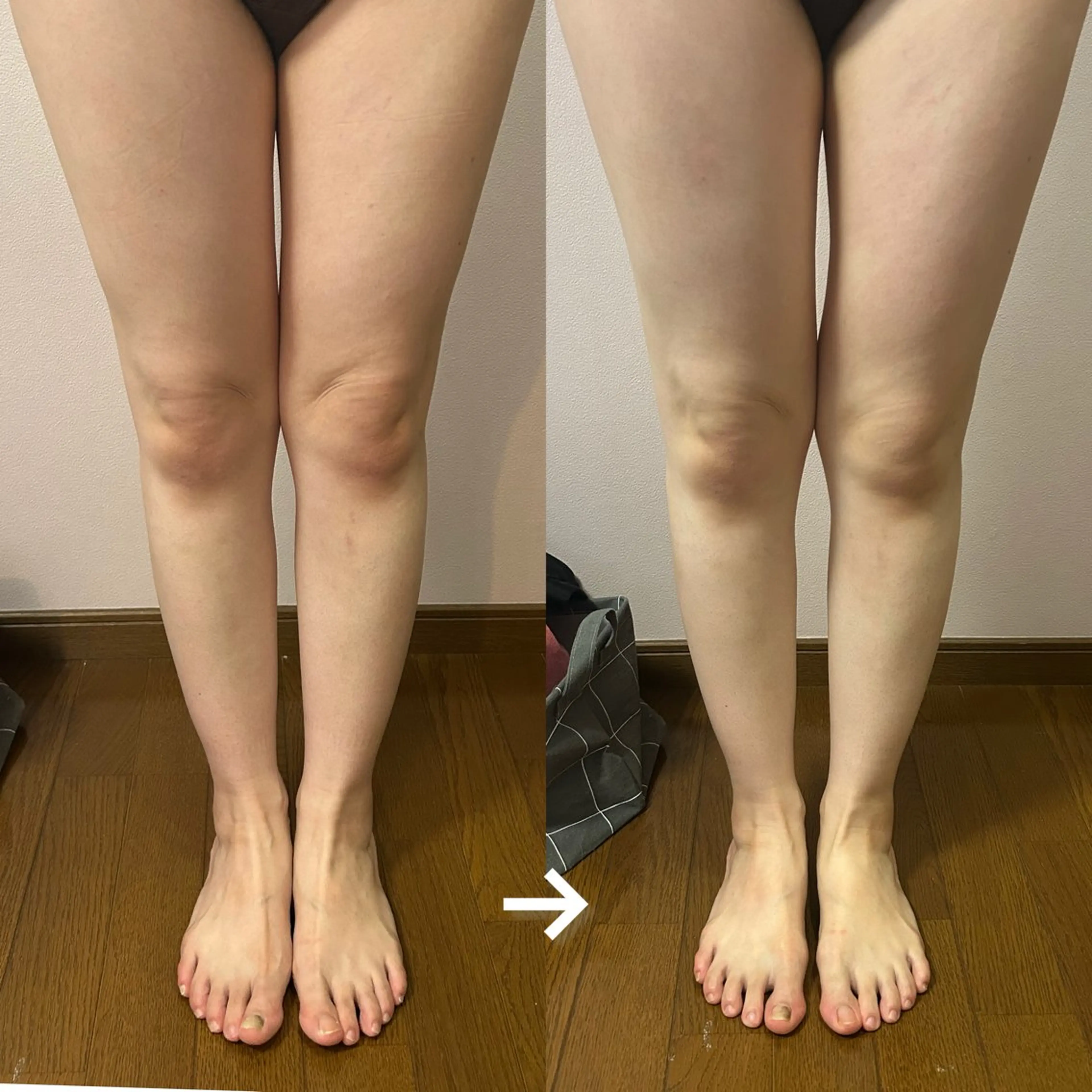 美脚エステの写真