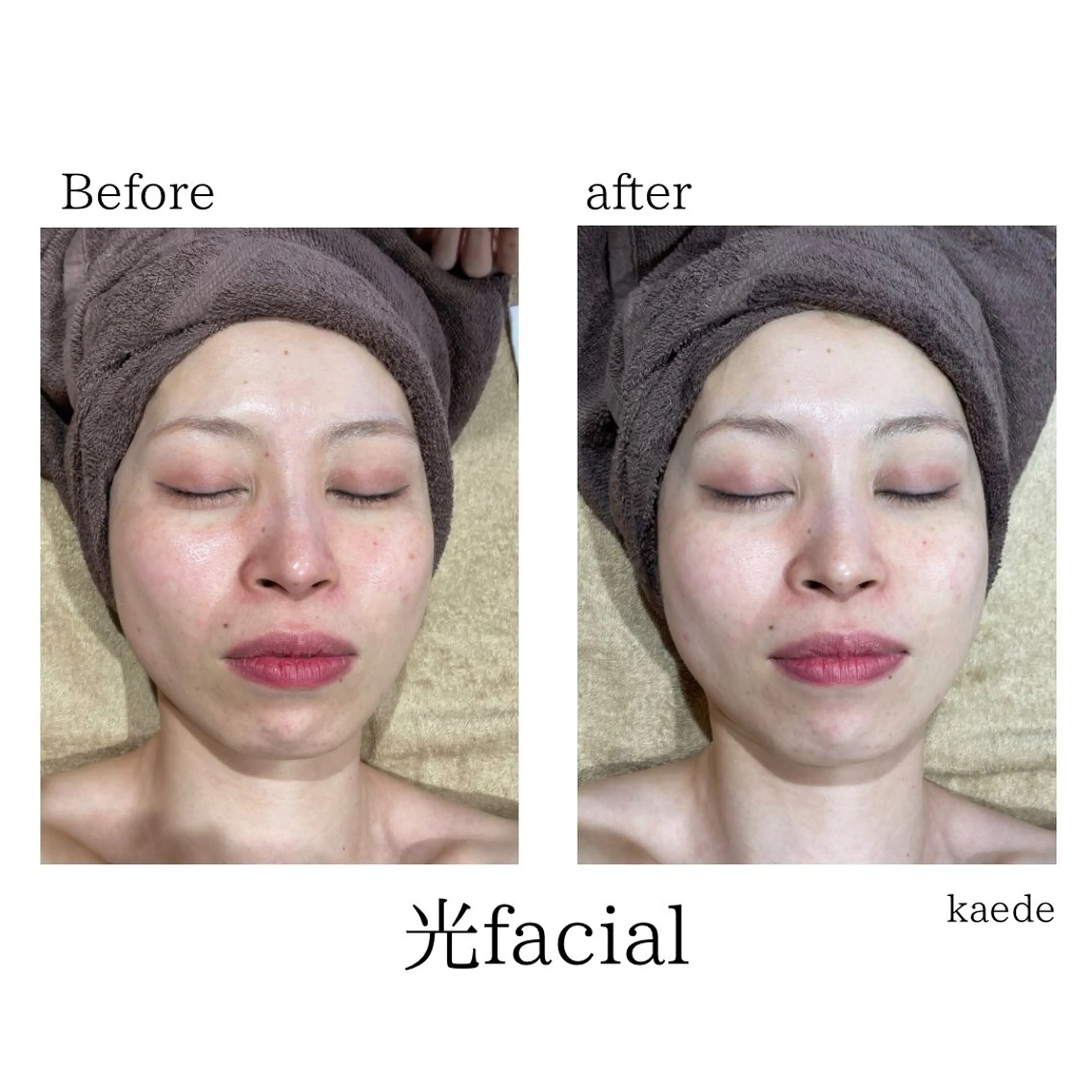 エステ 🎀kaede🎀 骨格似合わせ眉毛の眉毛・アイブロウイメージ