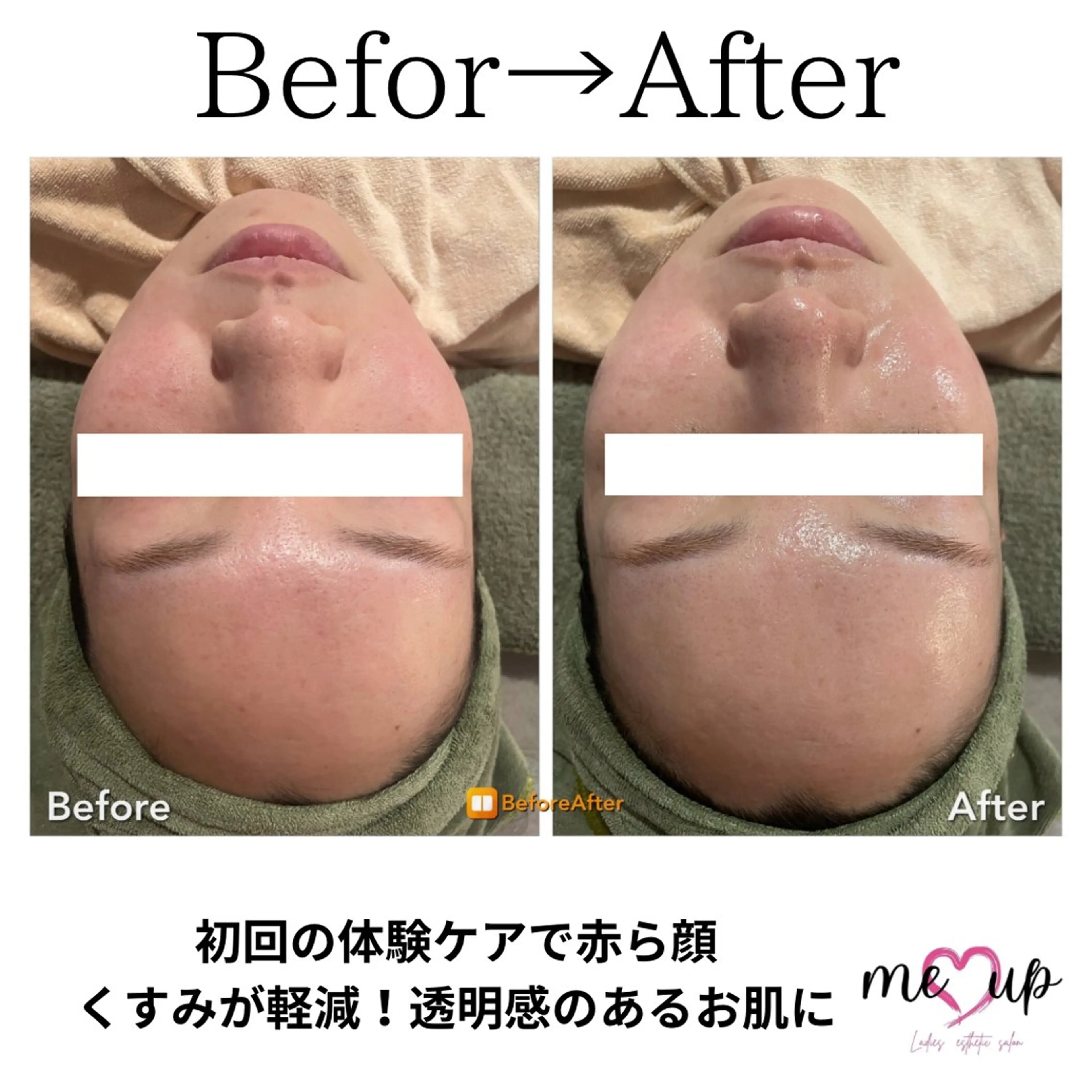 Meupニキビ専門店 背中/ハーブ/肌管理のその他イメージ