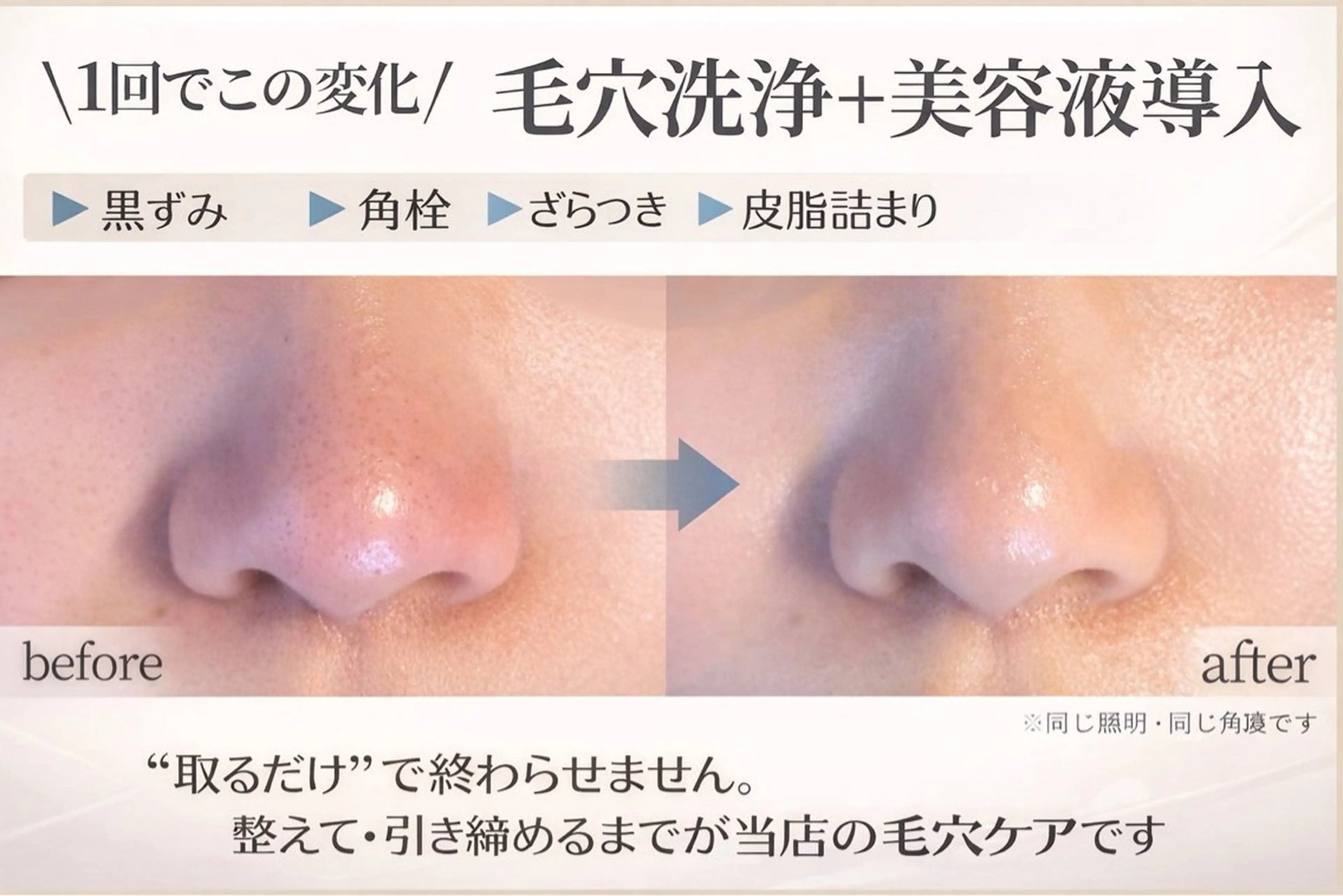 毛穴集中ケア　モニター様募集【本気でお肌を改善したいと思っている方】の写真