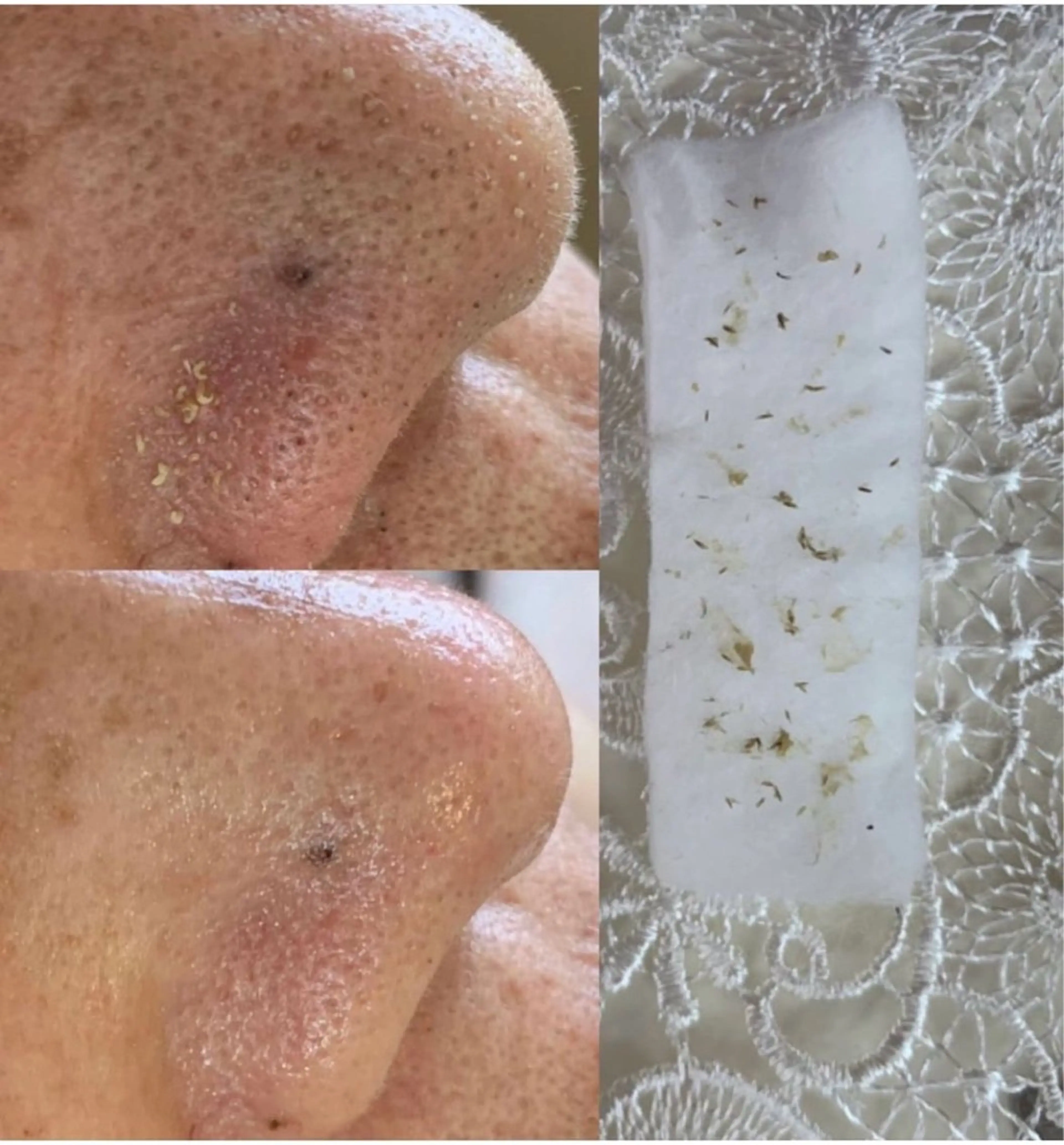 【人気No.1新規/平日10-15時】毛穴エクストラクション｢取った角栓が見える!｣の写真