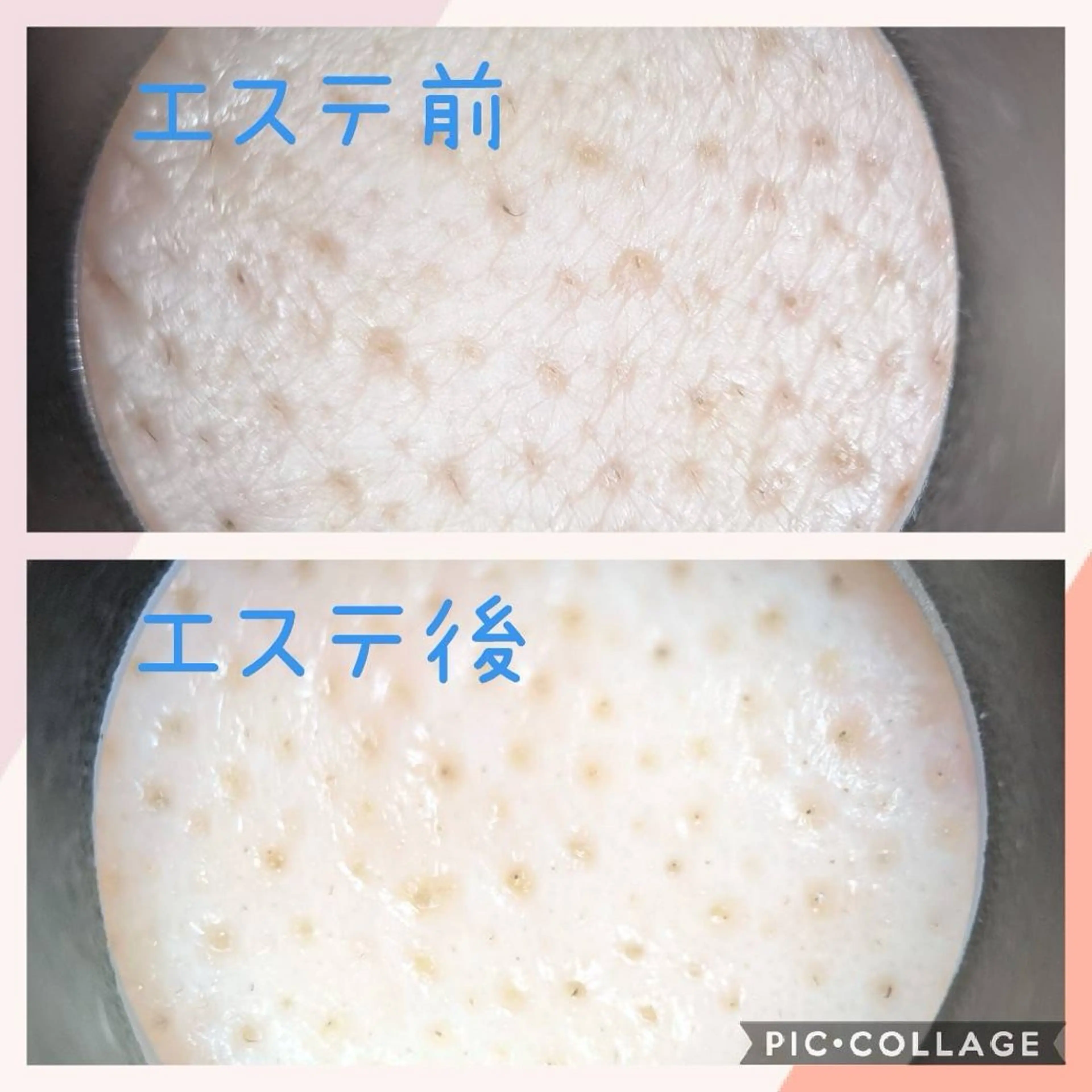 毛穴スッキリ✨️フェイシャルエステの写真