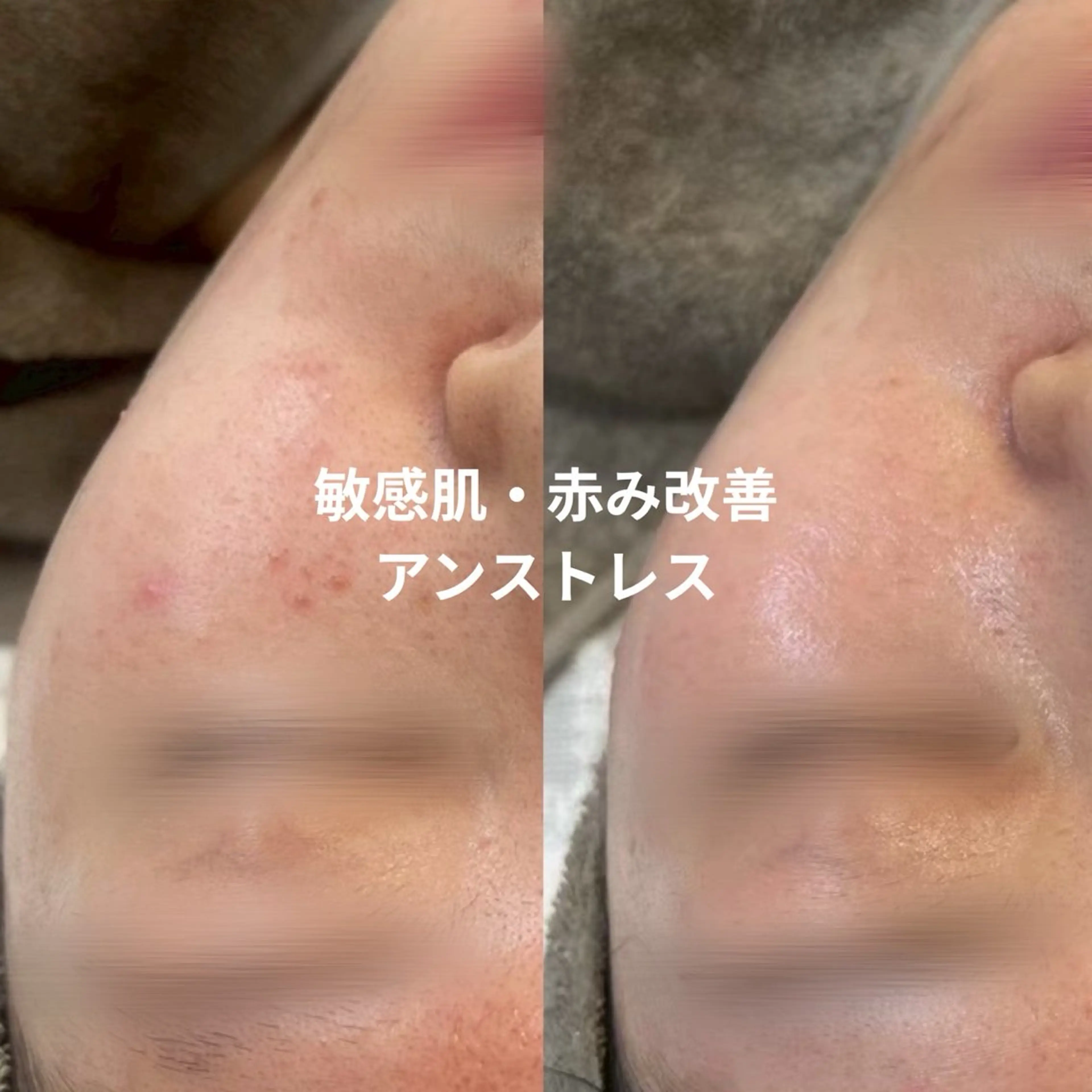 クリスティーナ アンストレス|赤み・ゆらぎ肌の鎮静ケア(アトピー肌でも◎)の写真