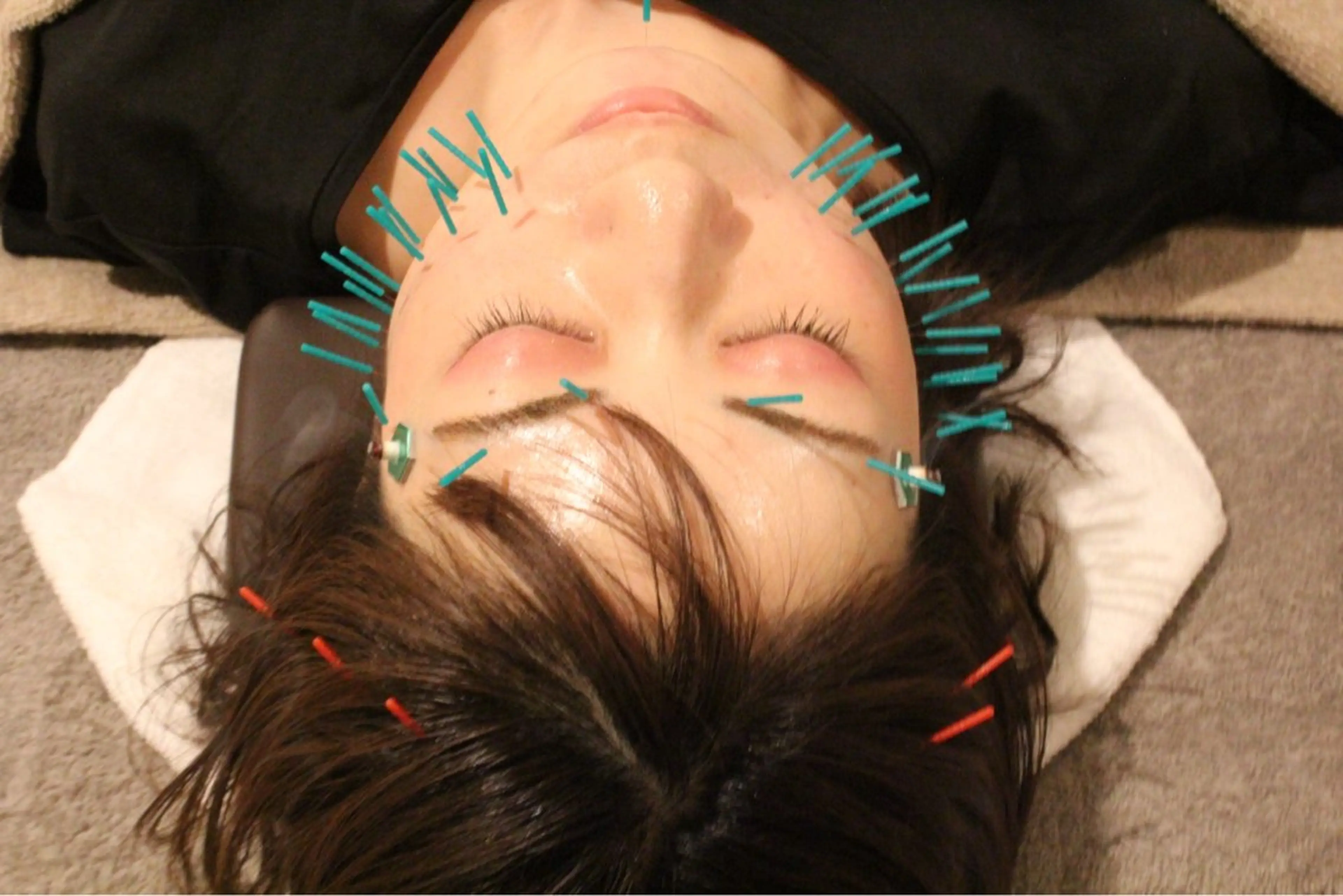 リフトアップNo.1🎖️【本数2倍📍たるみシワ】リフトアップ美容鍼➕ドライヘッドスパ　60分の写真