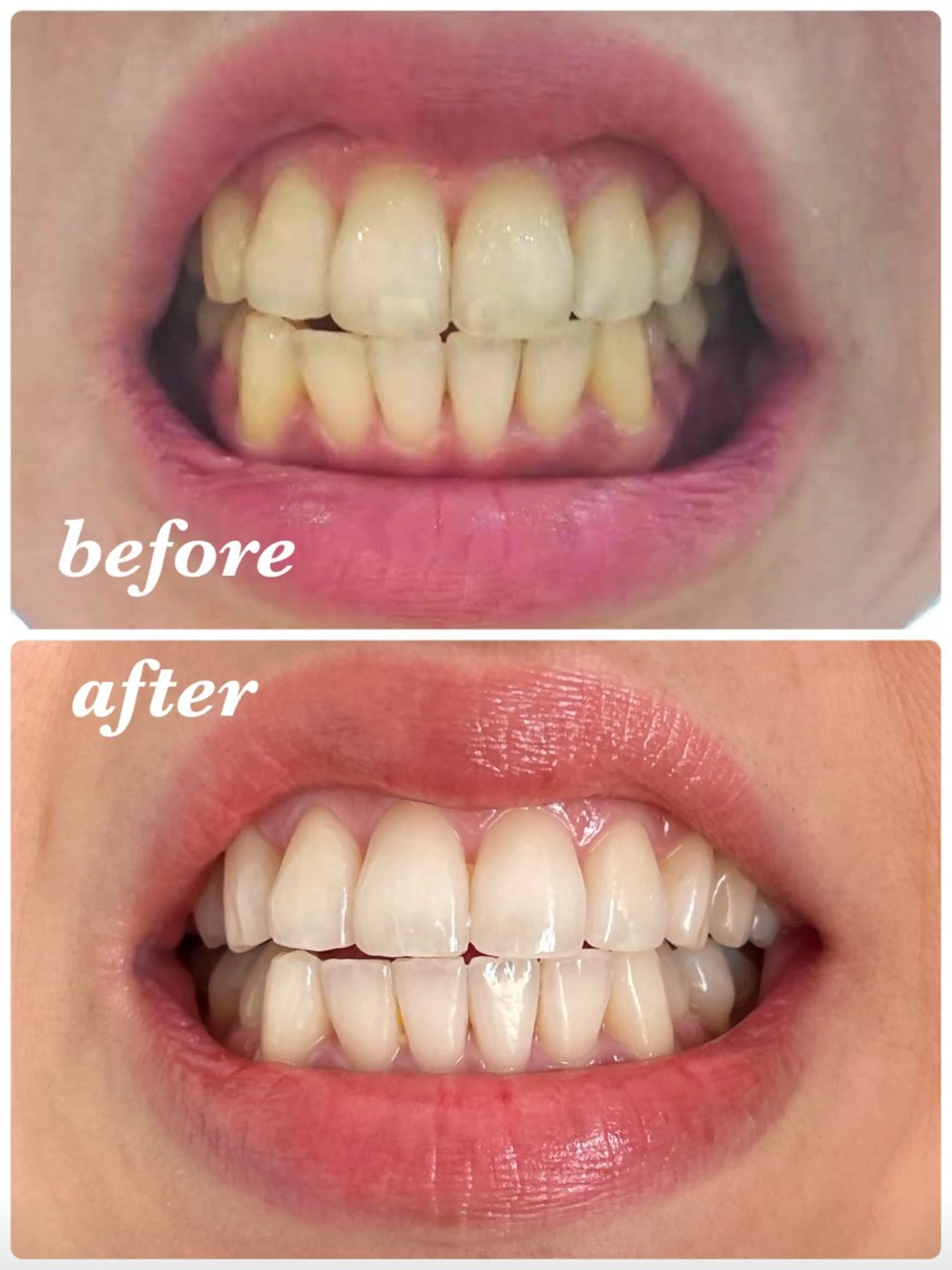 ホワイトニングのみご予約のお客様🩵セルフホワイトニング¥3300の写真