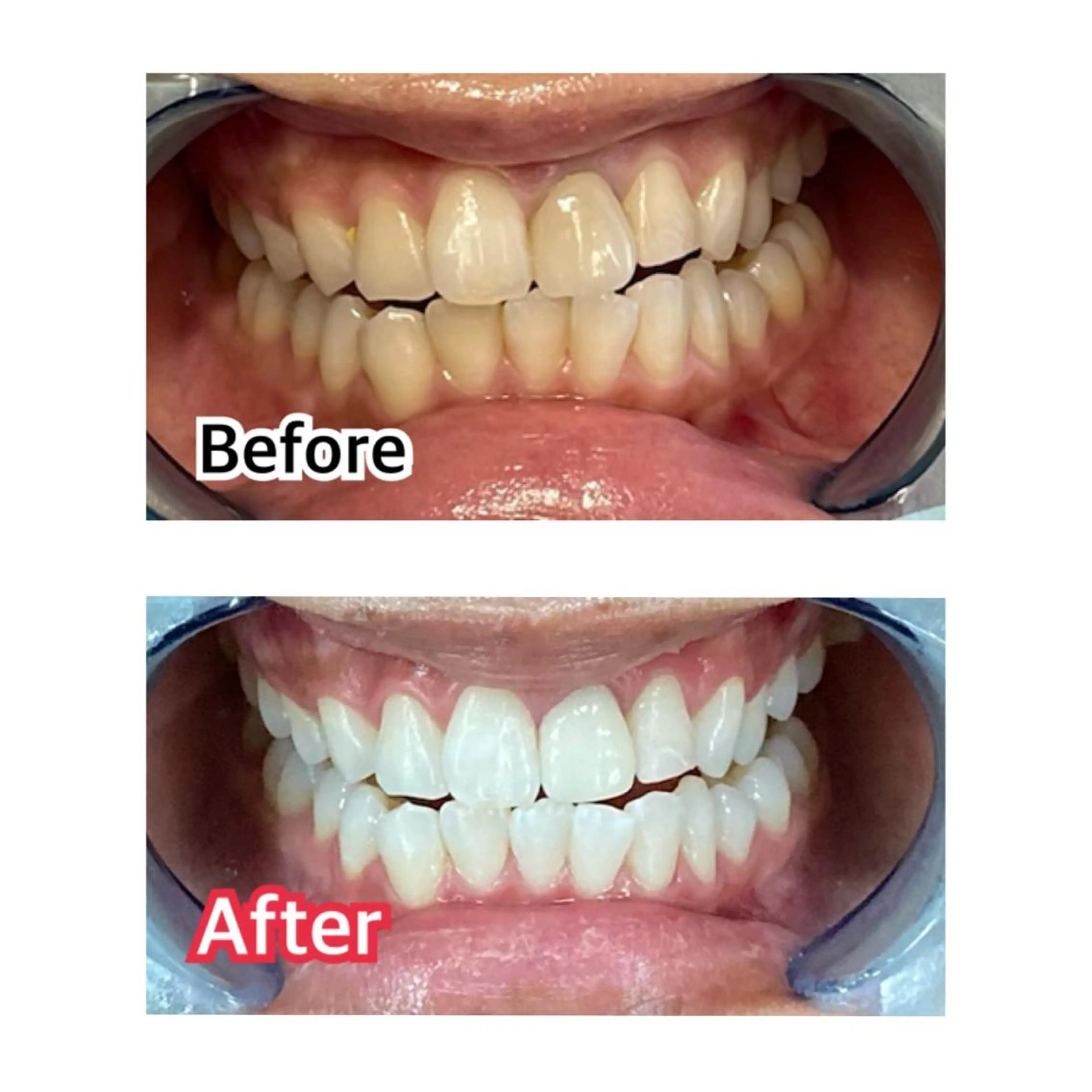 プラチナムビューティー柏所属・【歯科提携】柏ホワイ トニングスタイルのその他イメージ