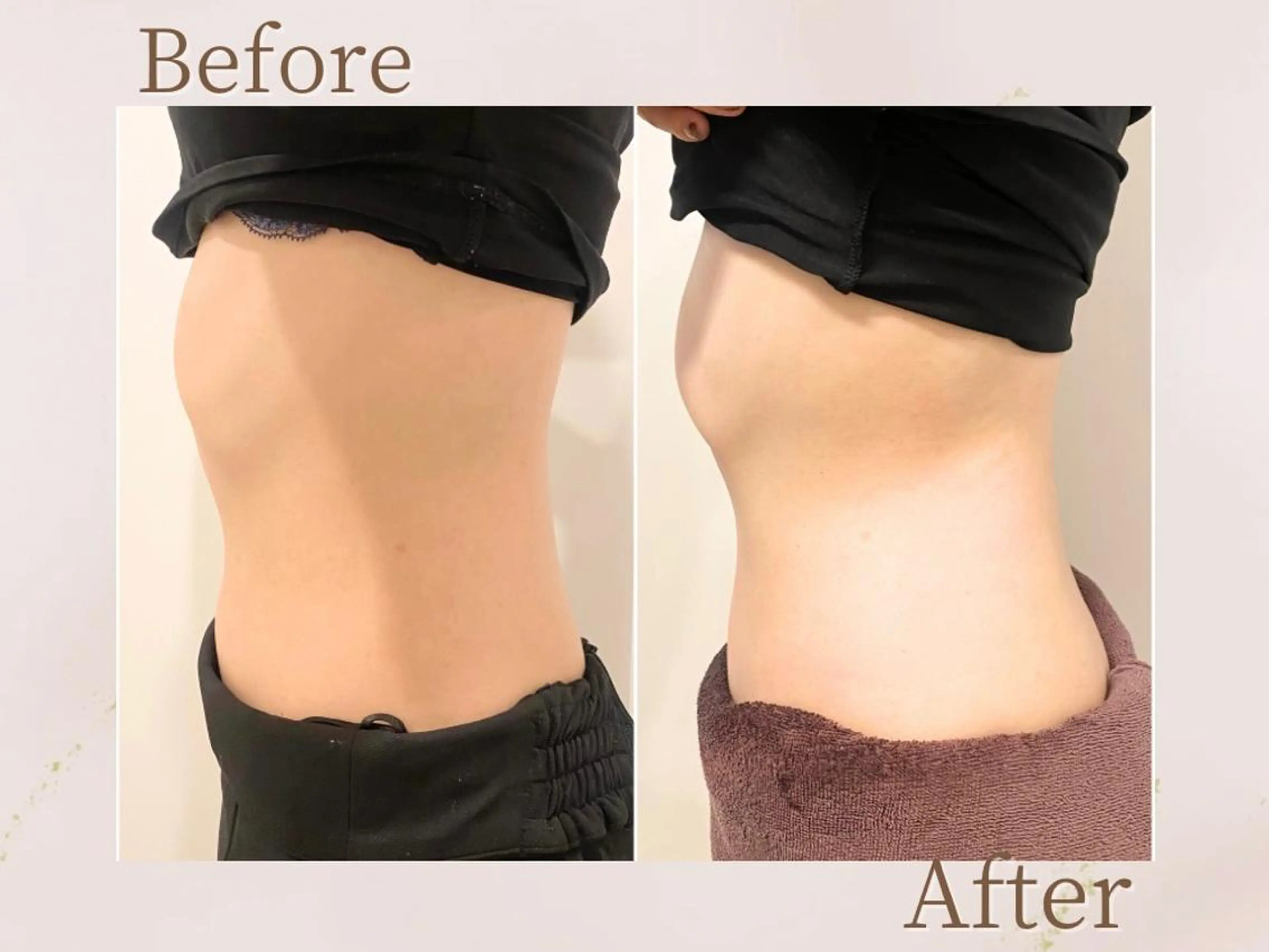 【ミニモ限定価格★モニター痩身】上半身キャビテーション×EMS¥19,000→¥8,000の写真