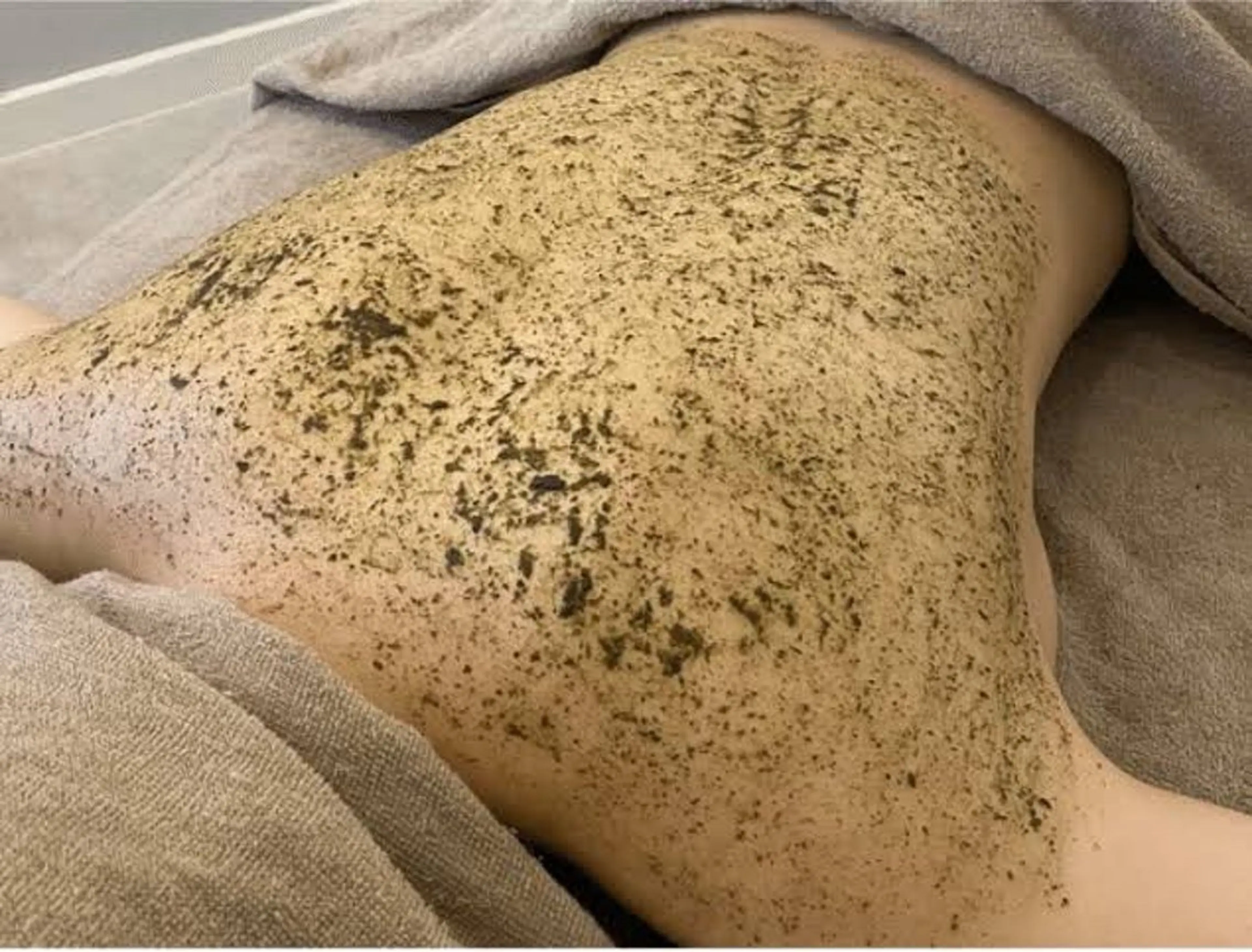 【ミニモ限定🩷背中のにきび・毛穴に✨】剥離なしハーブピーリング🌿🇰🇷の写真