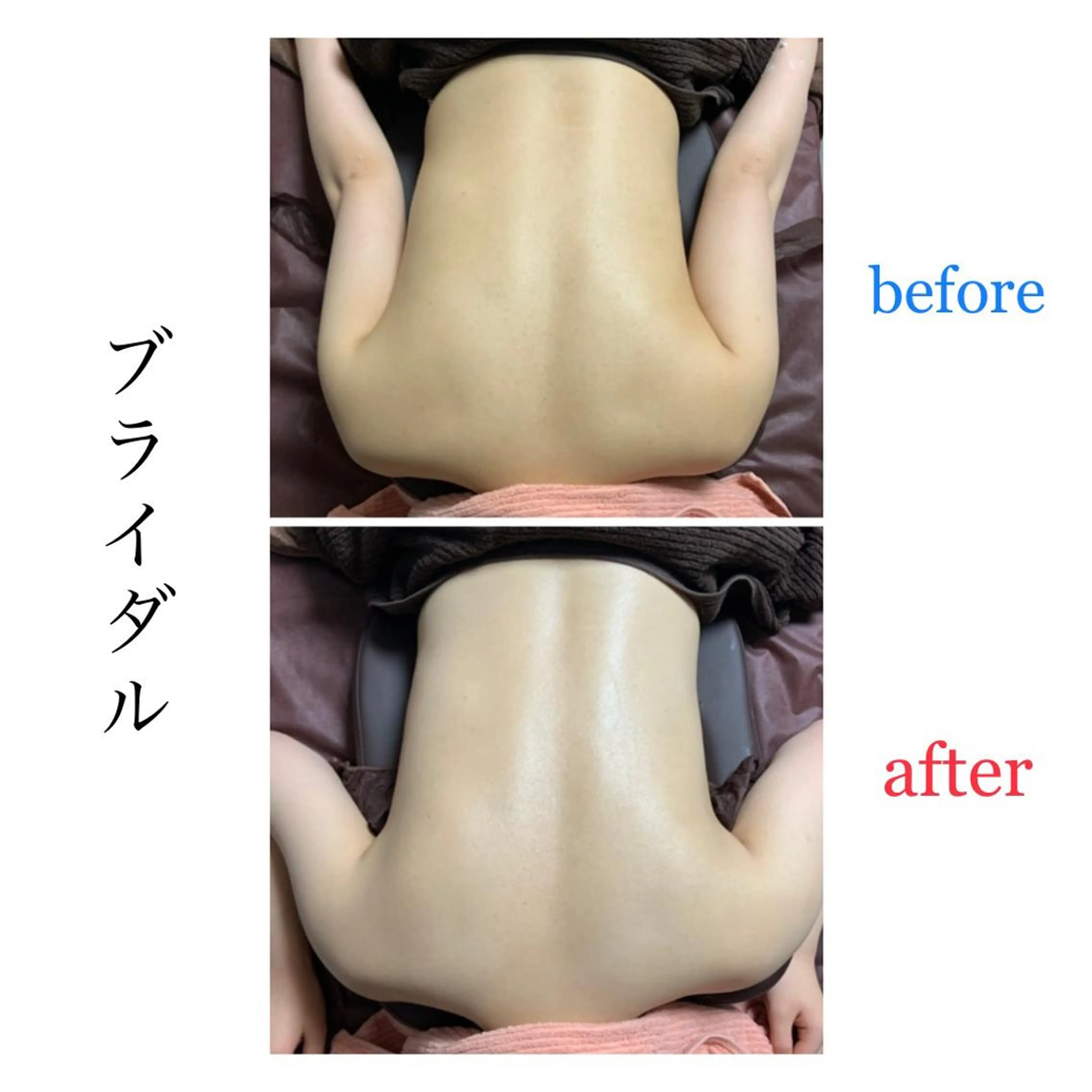 ブライダル【即効美白パック 両腕 45分】の写真