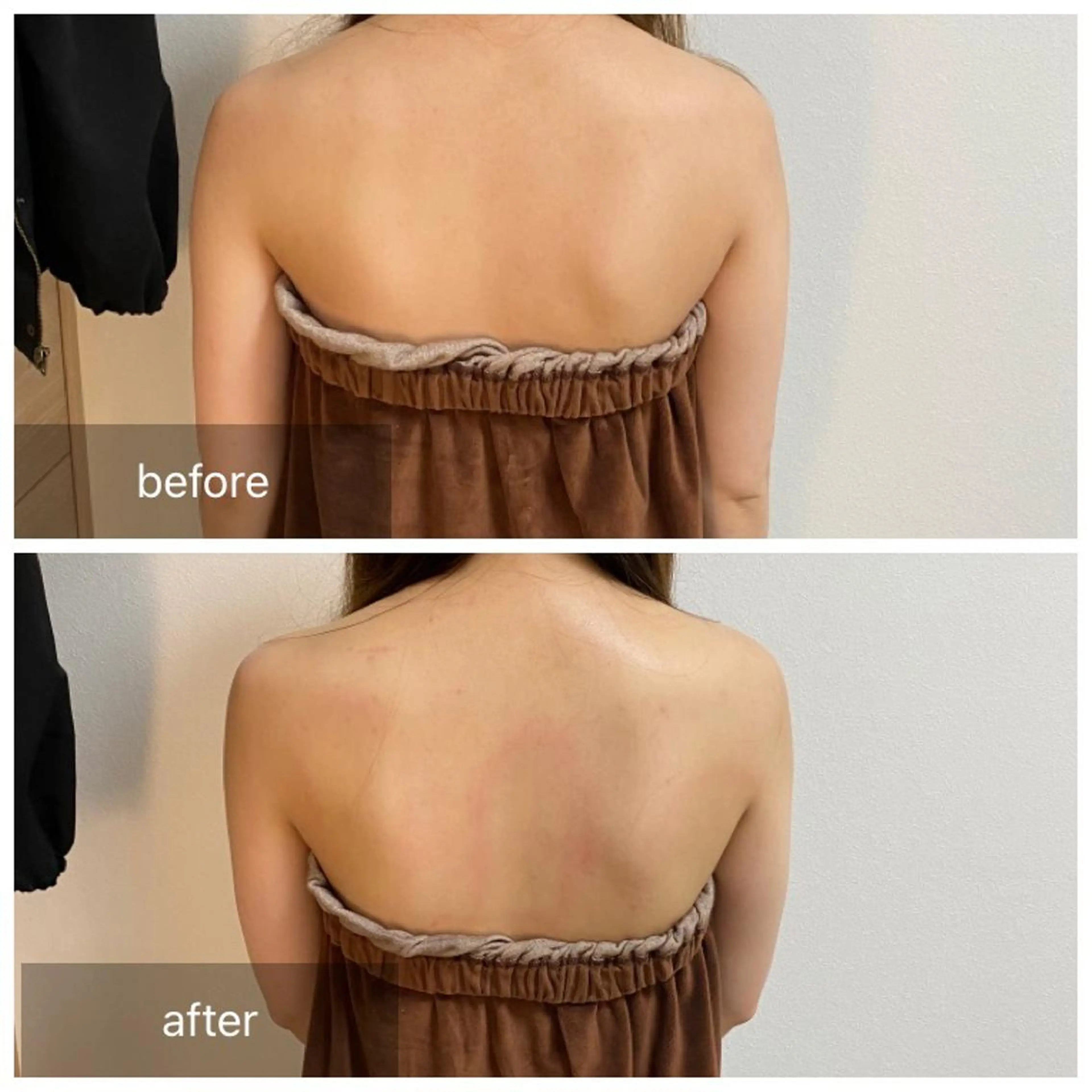 デコルテ&背中＆首仰向けトリートメント🫶上半身トリートメントです🫶ウエディングのお客様にも人気です❤️の写真