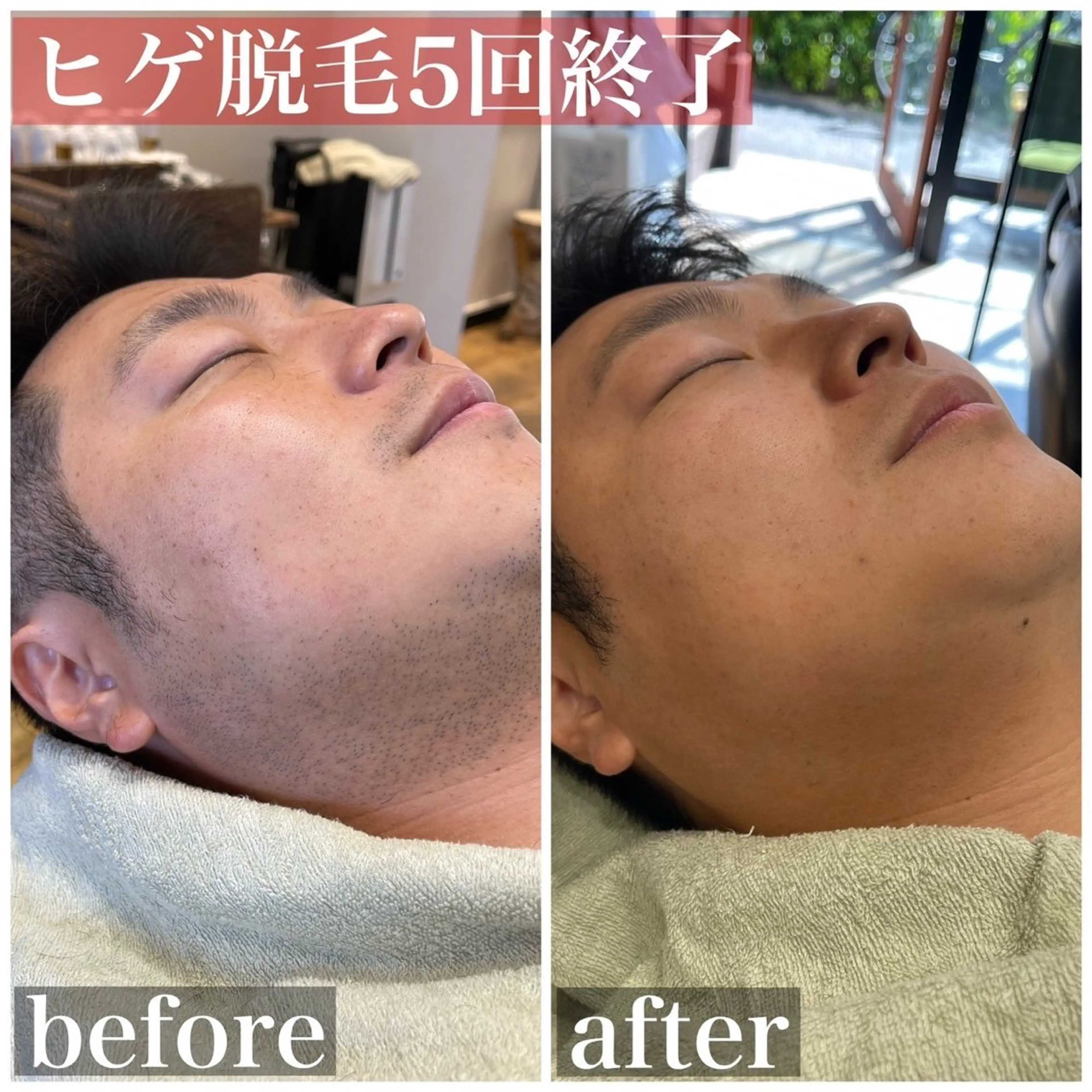 脱毛 HAIRS YOSHIOKA所属・ヘアーズヨシオカ MENSヒゲ脱毛のエステ・リラクイメージ