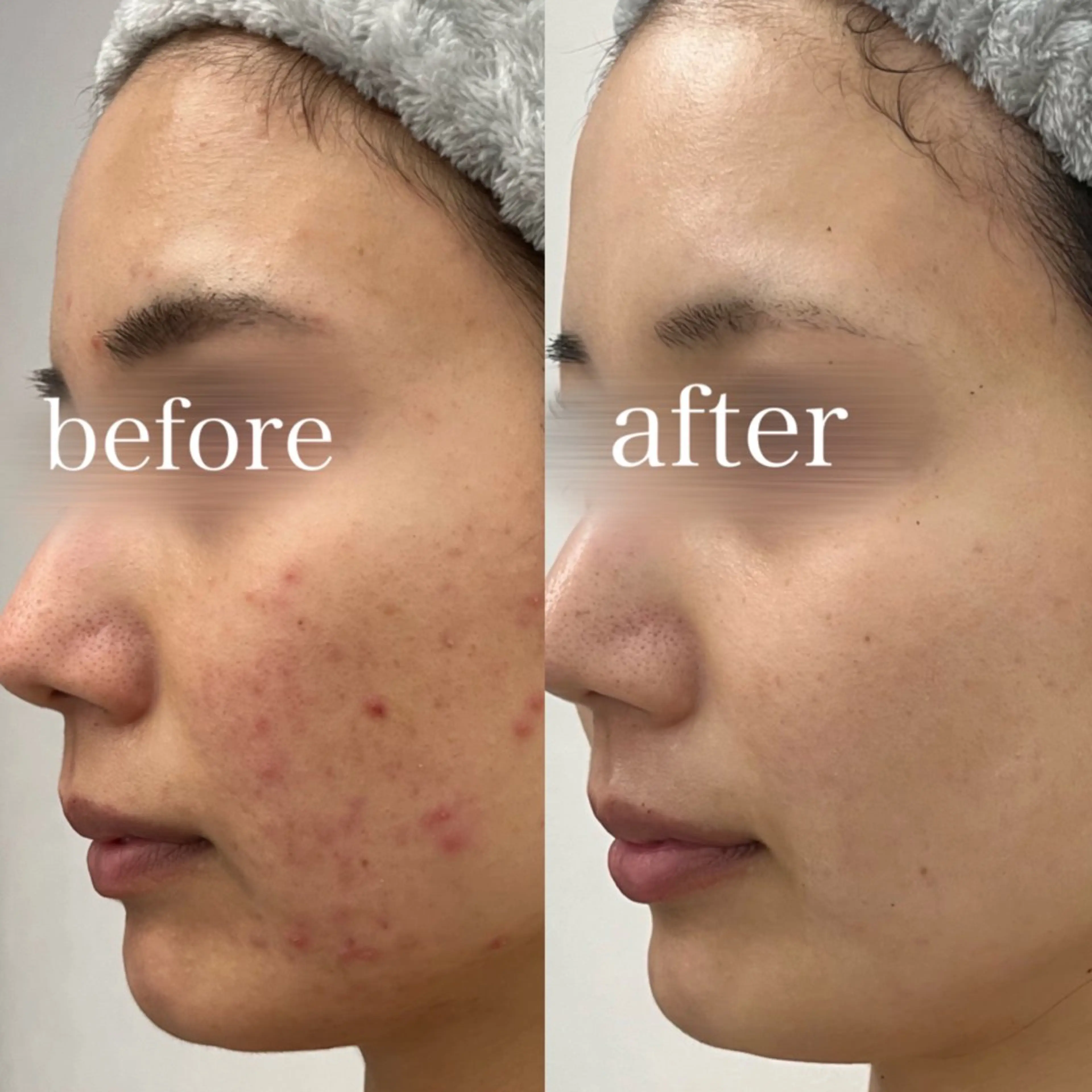 エステ REVIハーブピーリング/バストケア/脱毛 Retea.【ルテア】所属・ハーブピーリング| 毛穴洗浄|ルテアのエステ・リラクイメージ