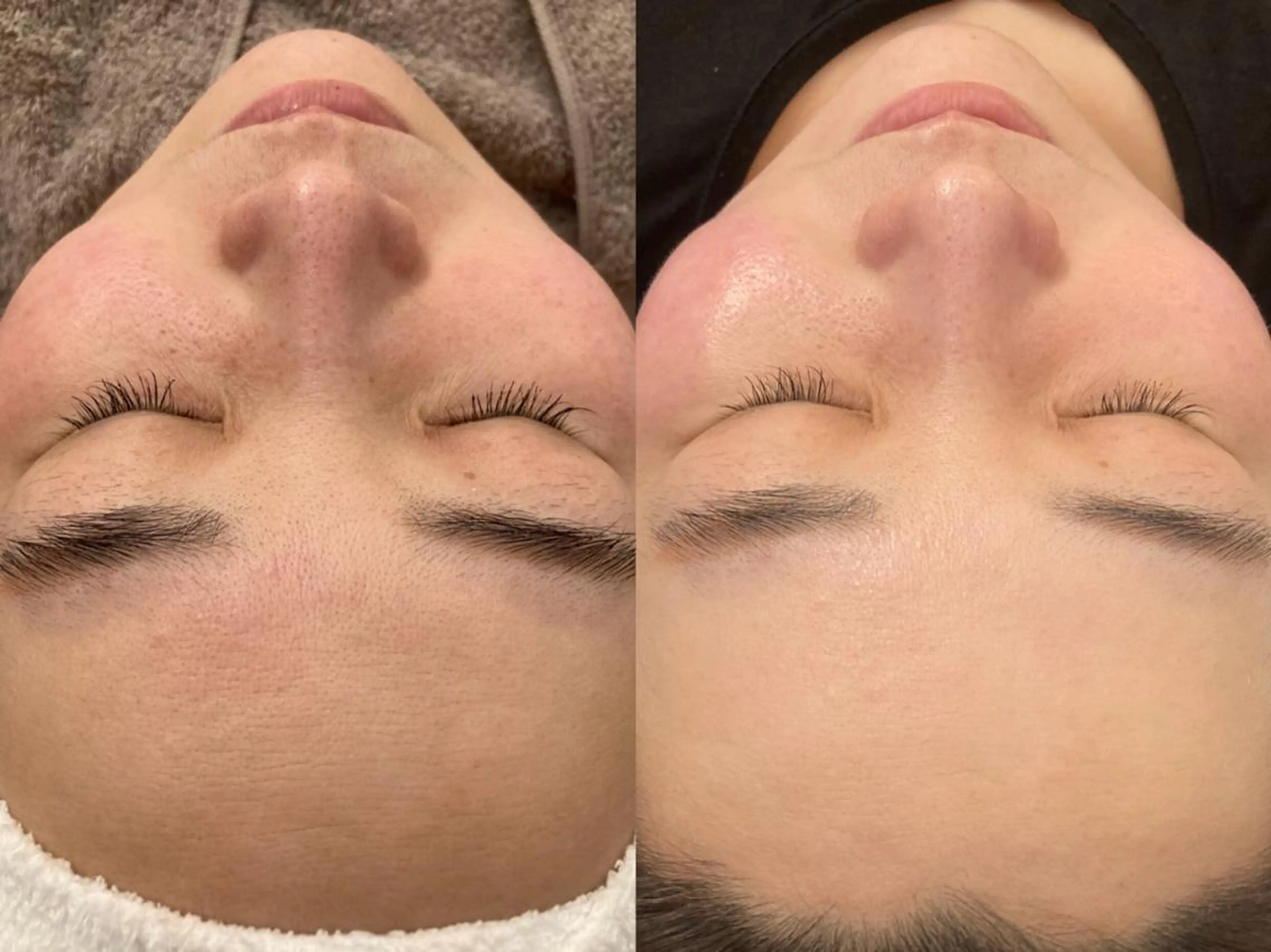 【エステ版ダーマPEN】新メニュー登場☆水光ダーマジェット!初回限定￥11,000の写真