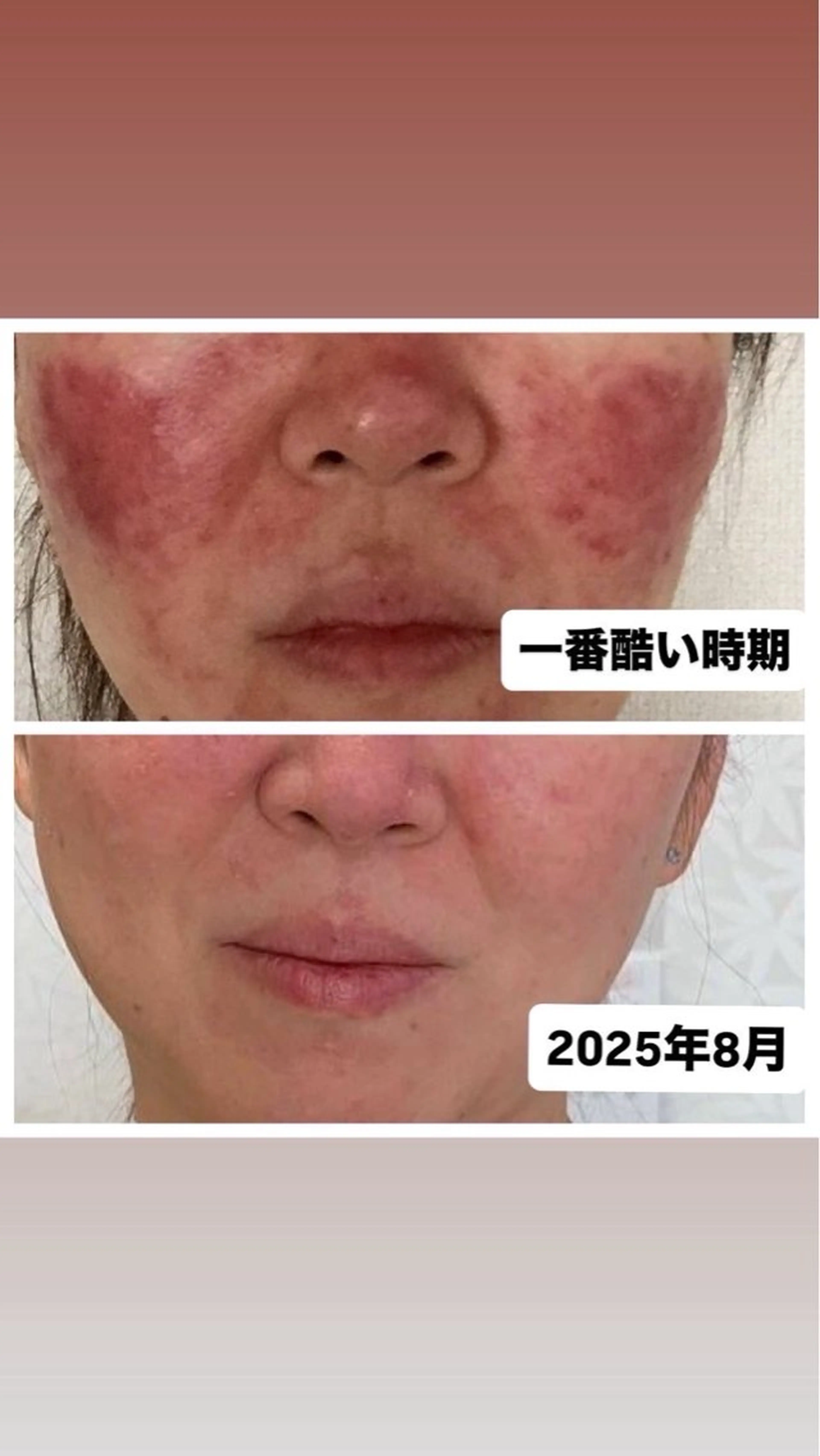 【キメの整った乾燥に負けないハリ艶肌へ】世界特許ヒト幹細胞ポレーション×炭酸パック★高級ホームケア付✨自分への贅沢ケアにの写真