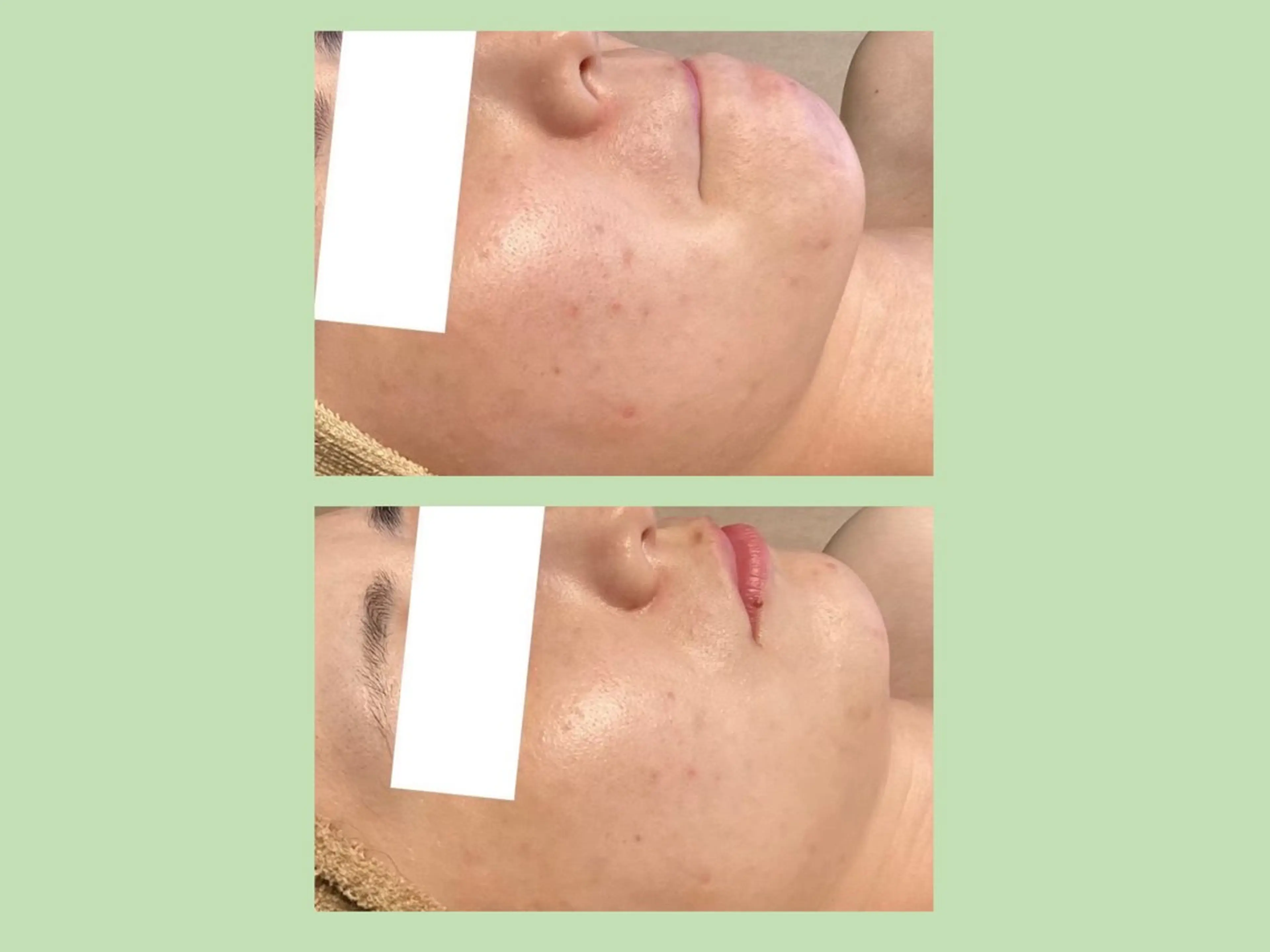 小顔・ツルツル素肌 ハリステリアのエステ・リラクイメージ