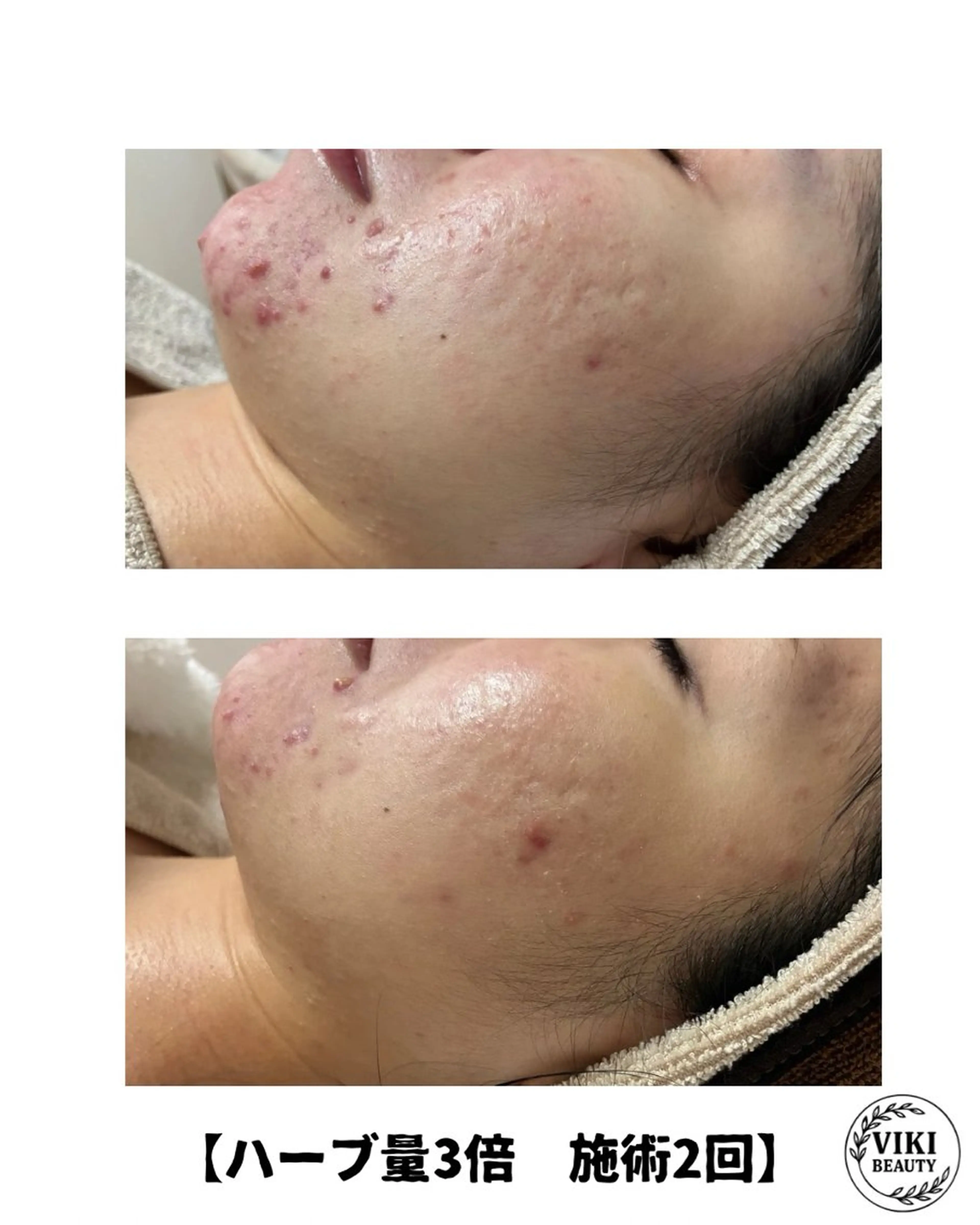 VIKI BEAUTY  クレイハーブピーリング・美肌脱毛専門店所属・VIKI BEAUTYのエステ・リラクイメージ