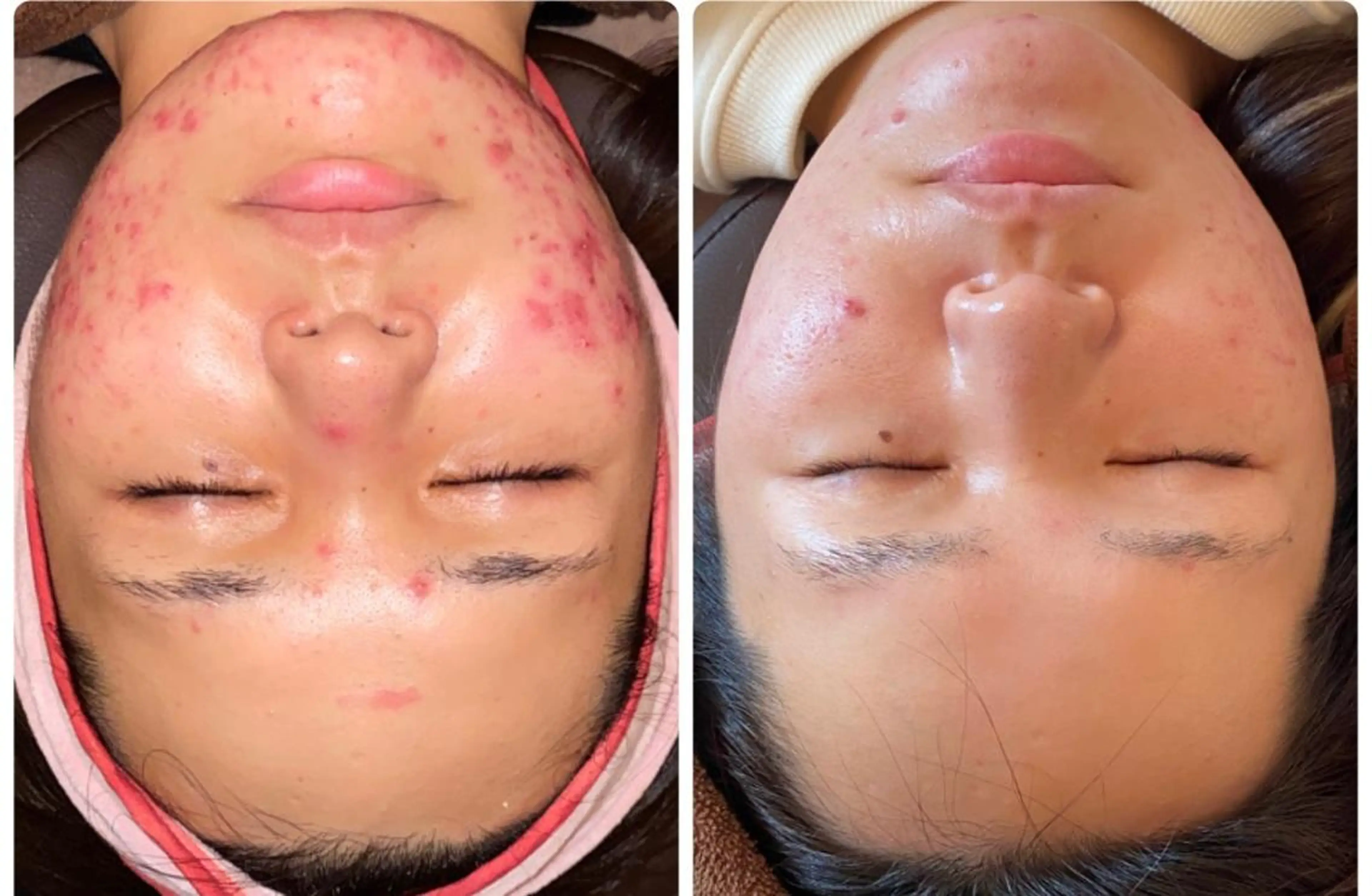 ✨🌿FLEUR8周年特別メニュー🌿✨全顔ケア剥離ハーブピーリング🌿✨医療クリニック提携サロン🏥の写真