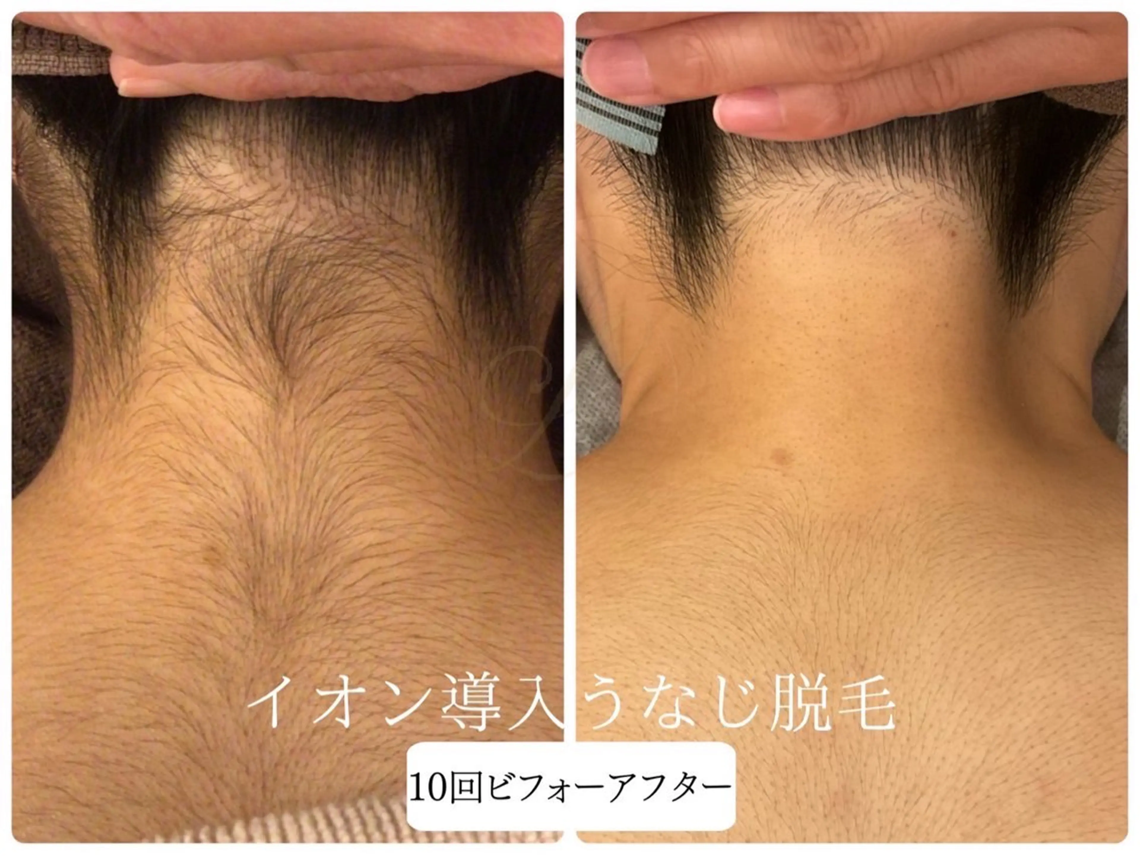 脱毛 Beauty  salon Lino所属・🎀うなじ脱毛🎀 ㅣLino堀江のエステ・リラクイメージ