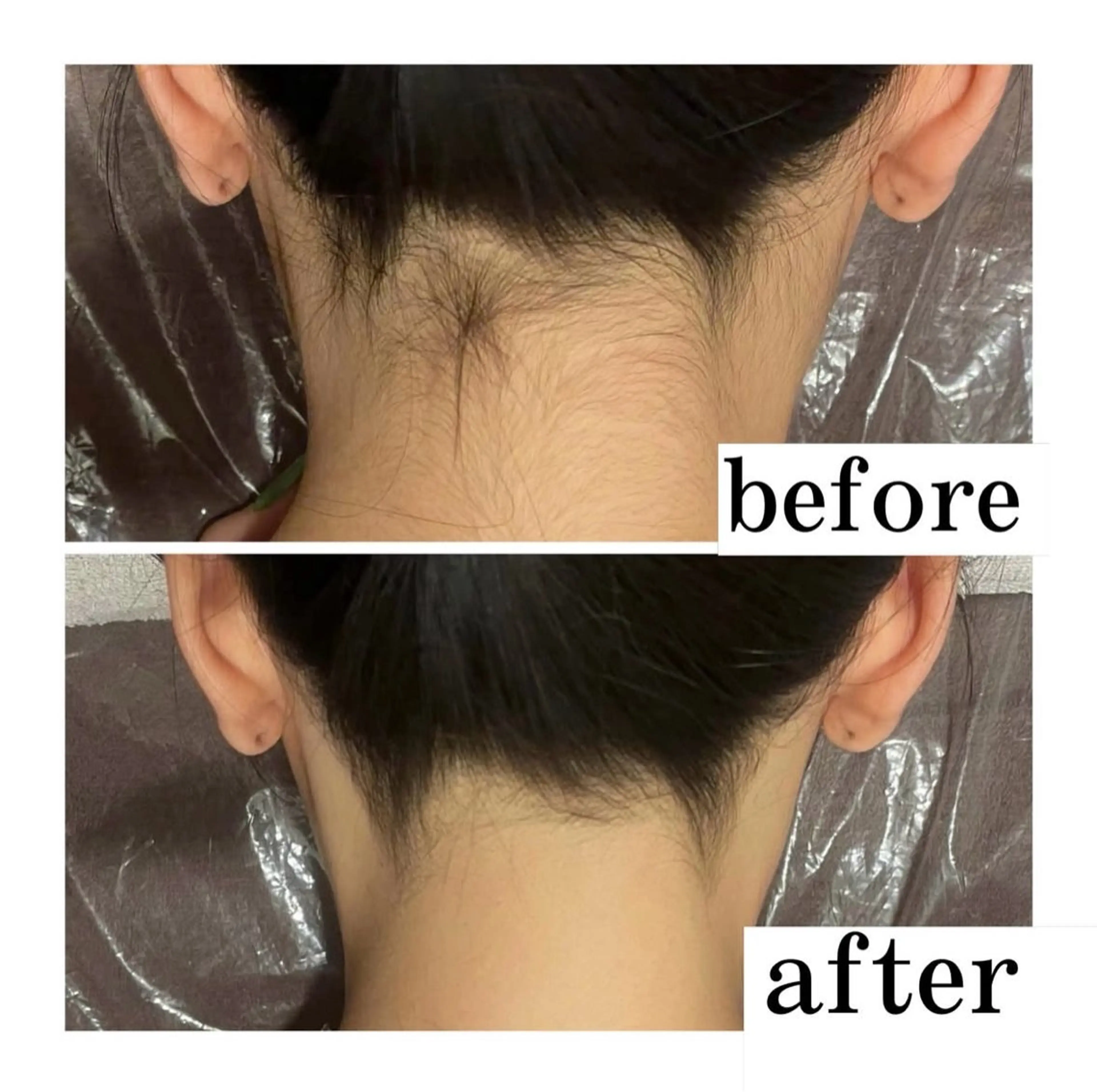 【18​〜​29歳限定】うなじ脱毛の写真