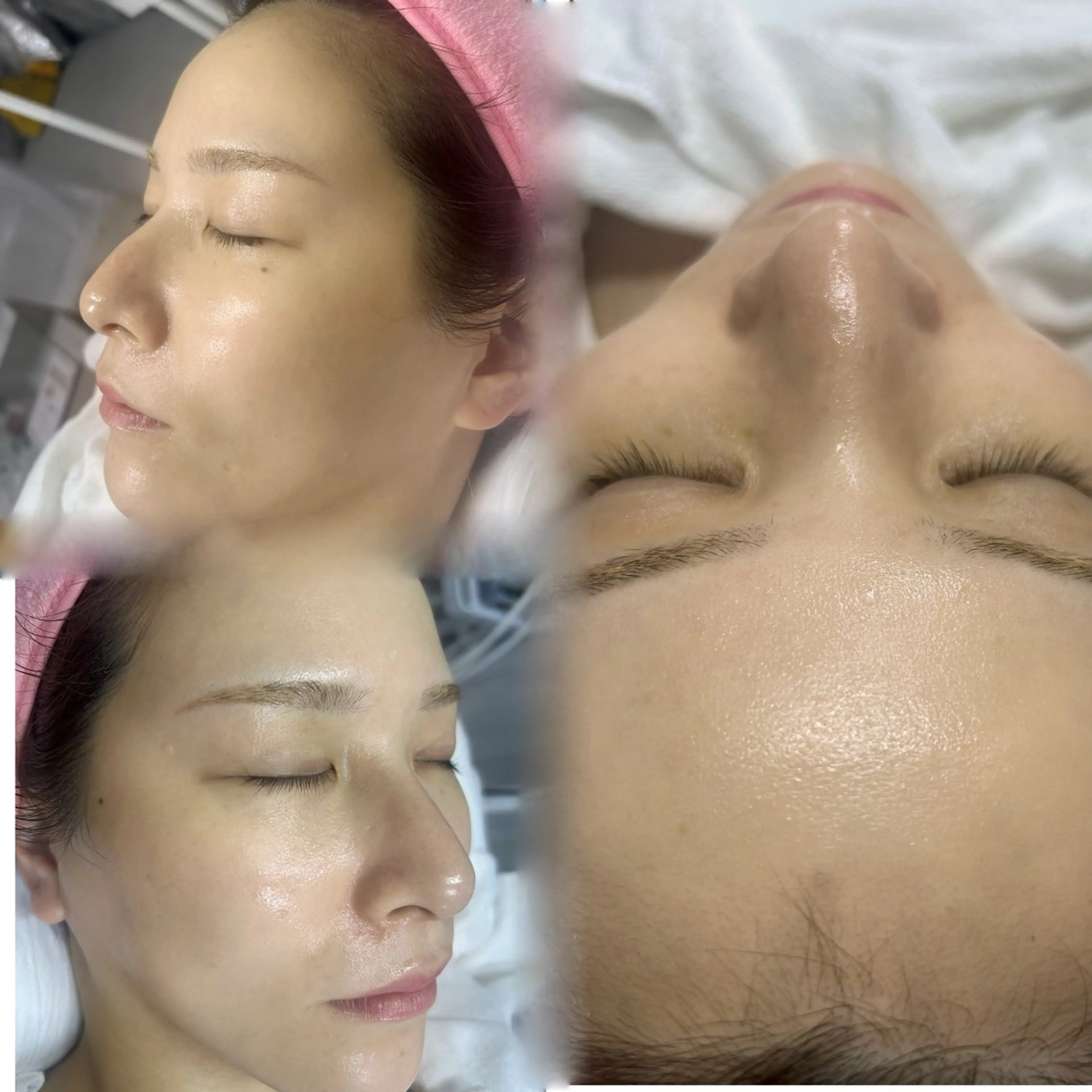 肌質改善(お悩み別トリートメント)の写真