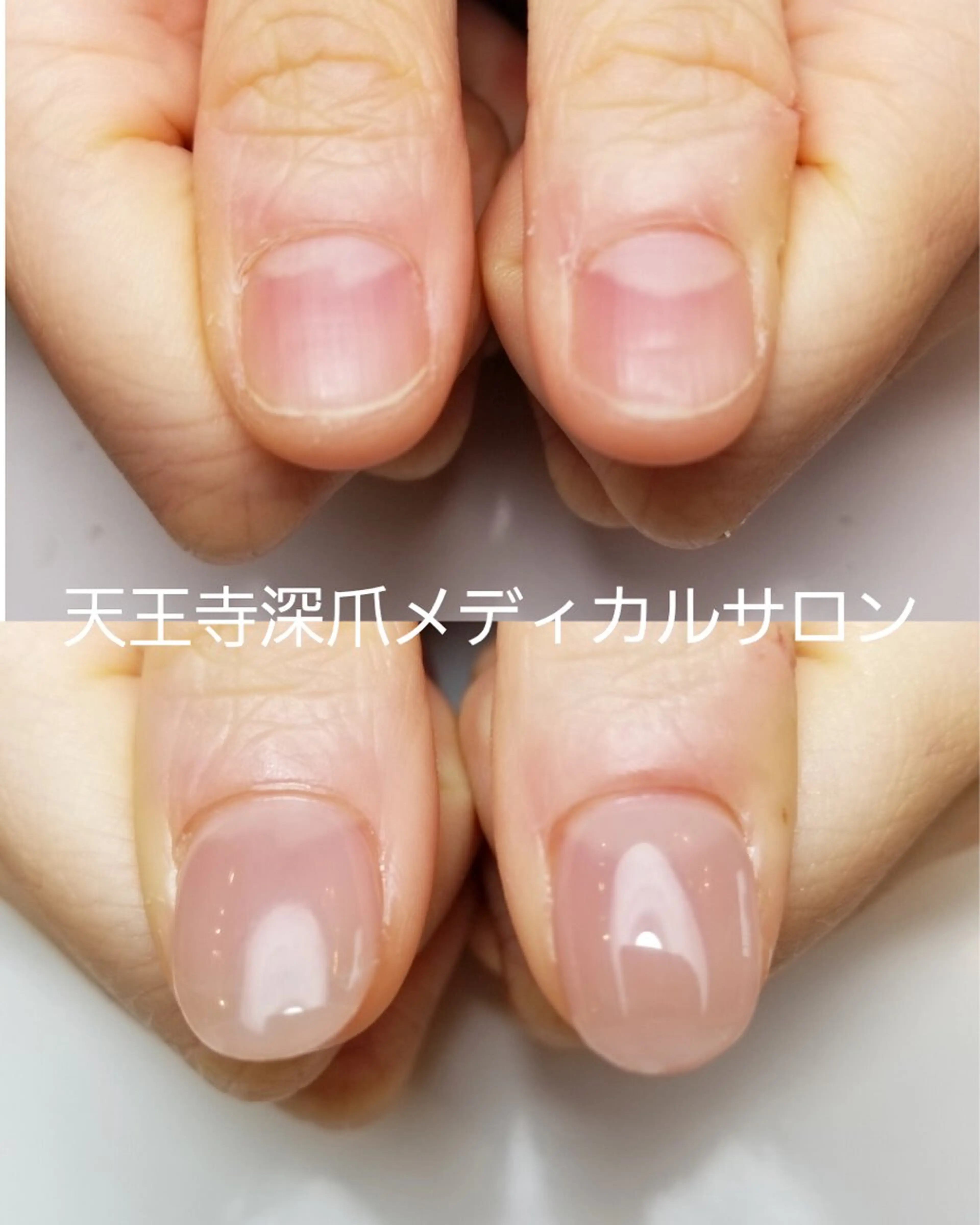 ネイル ハンドネイル ハンドケア 天王寺 深爪メディカルサロンのネイルデザイン
