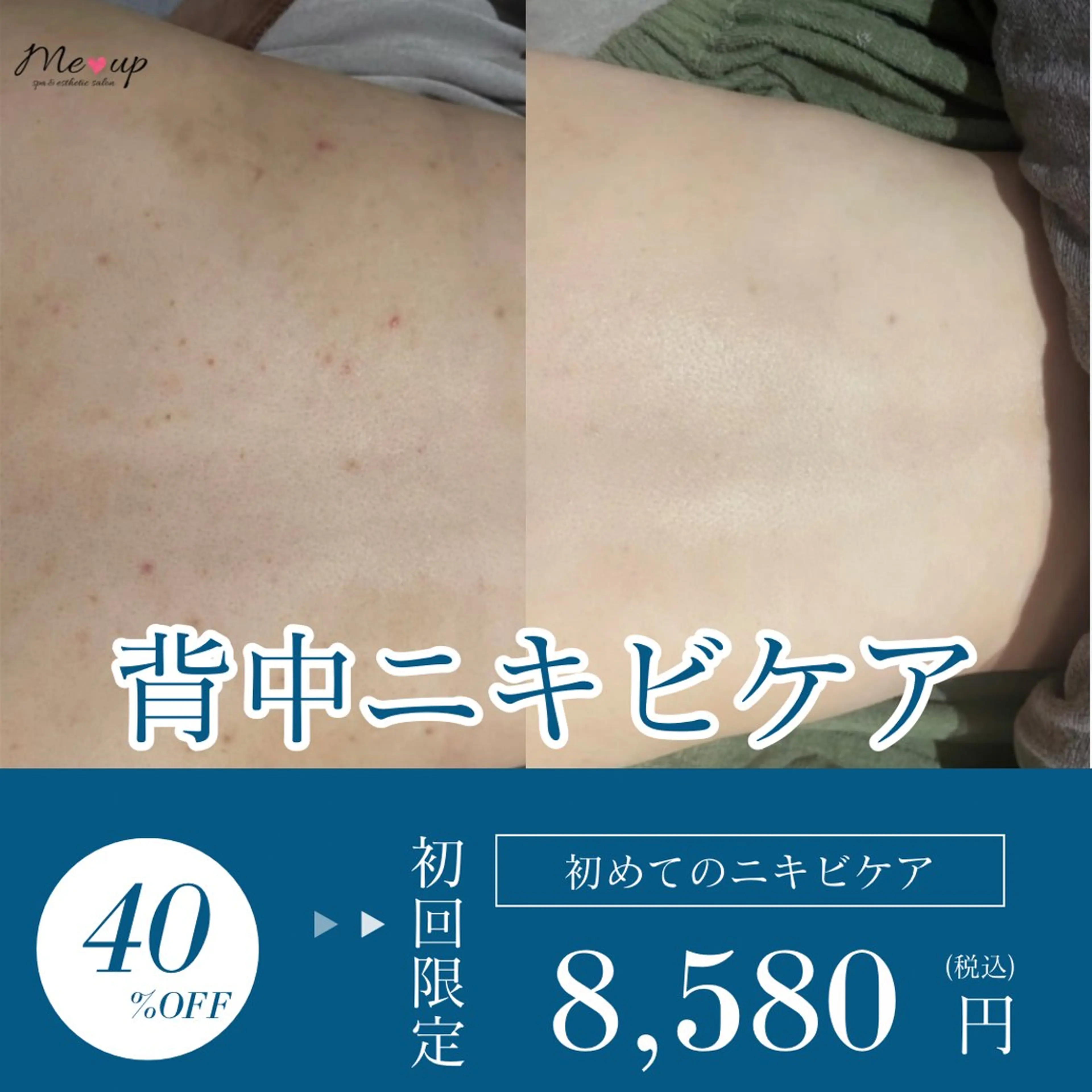 ご新規様★背中ケア★何を選んでいいかわからない方はこちら!の写真