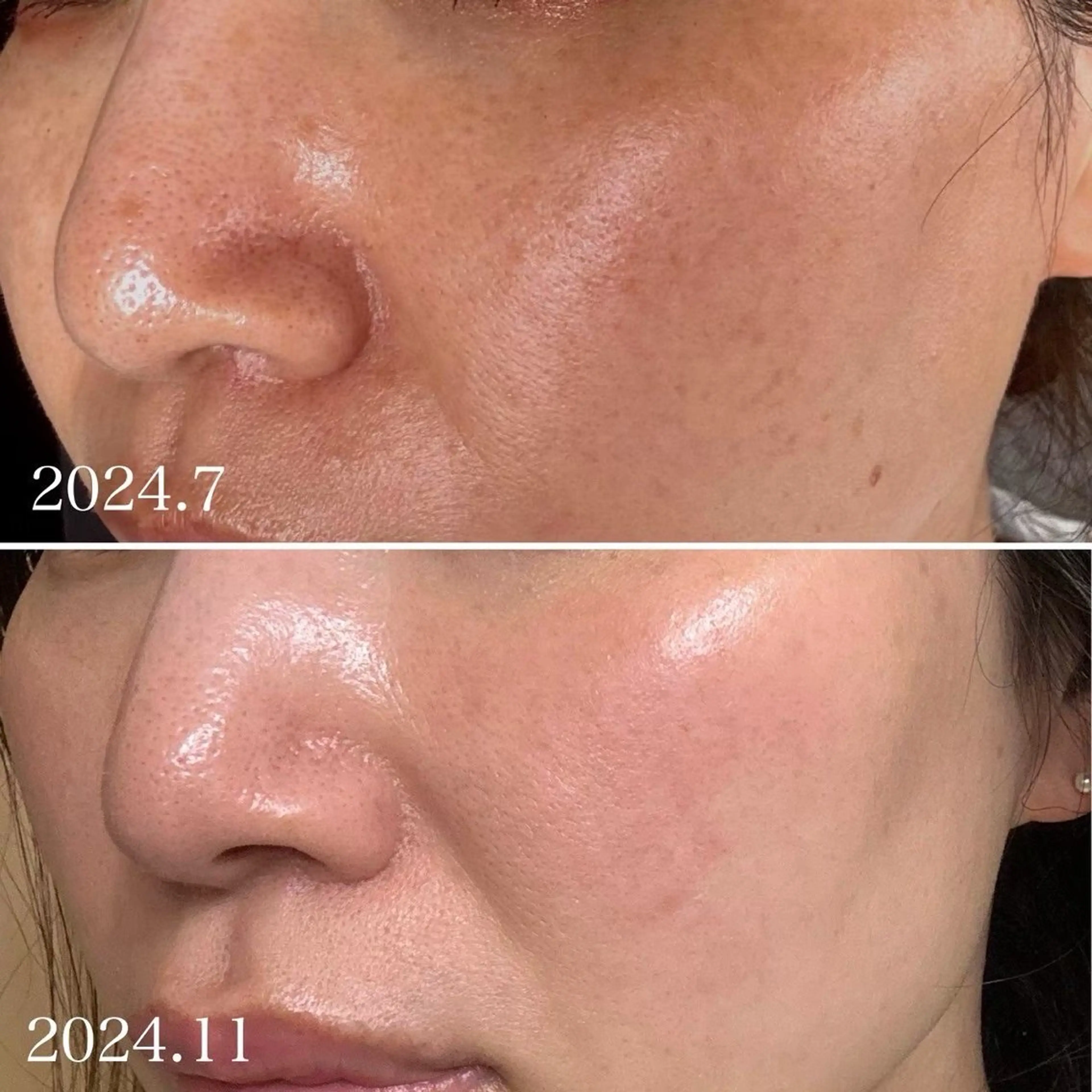 【お肌の生まれ変わり・褒められる肌へ！】剥離あり+なし/ブレンドハーブピーリング🌿DTあり/¥32000→¥16000の写真