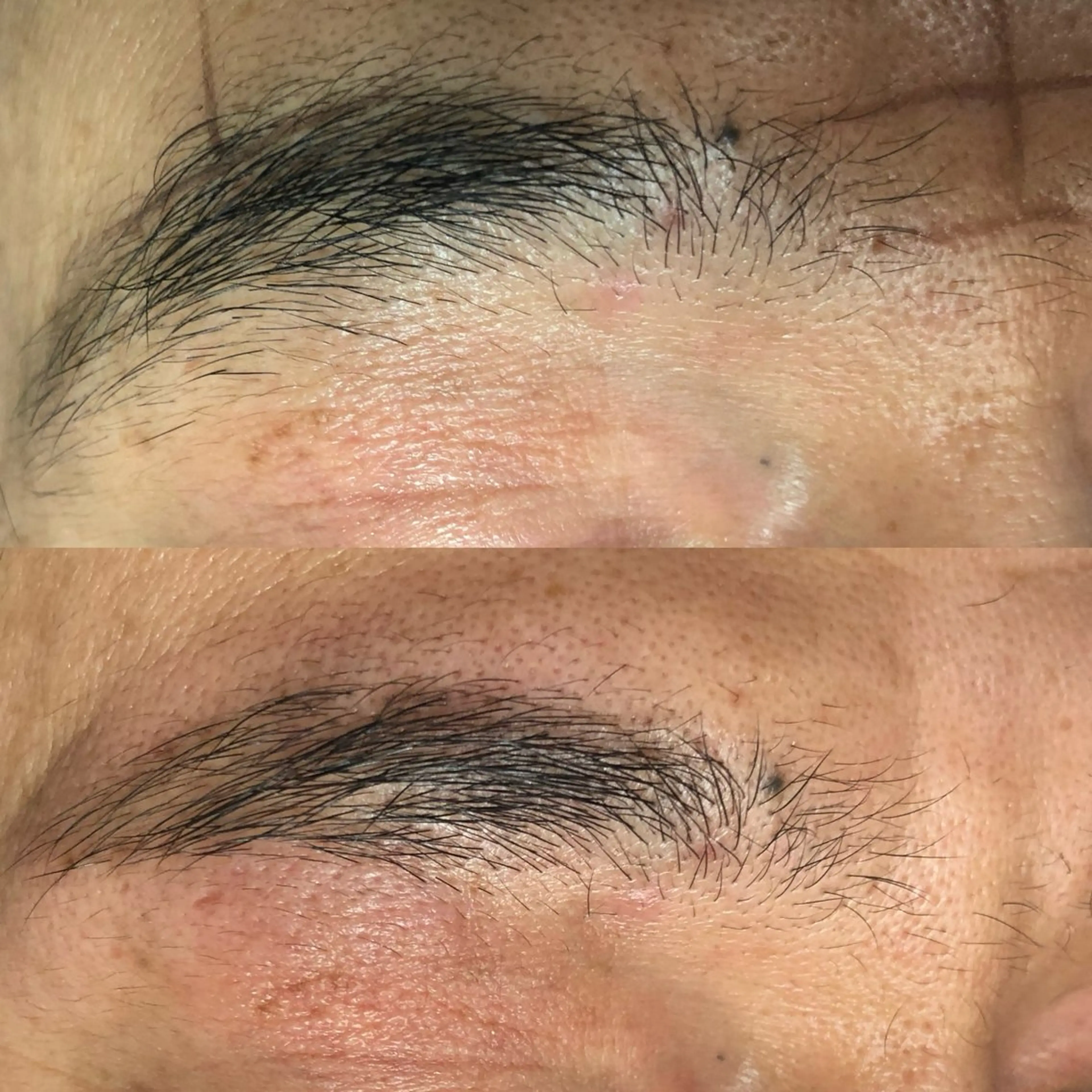 美容電気脱毛の写真