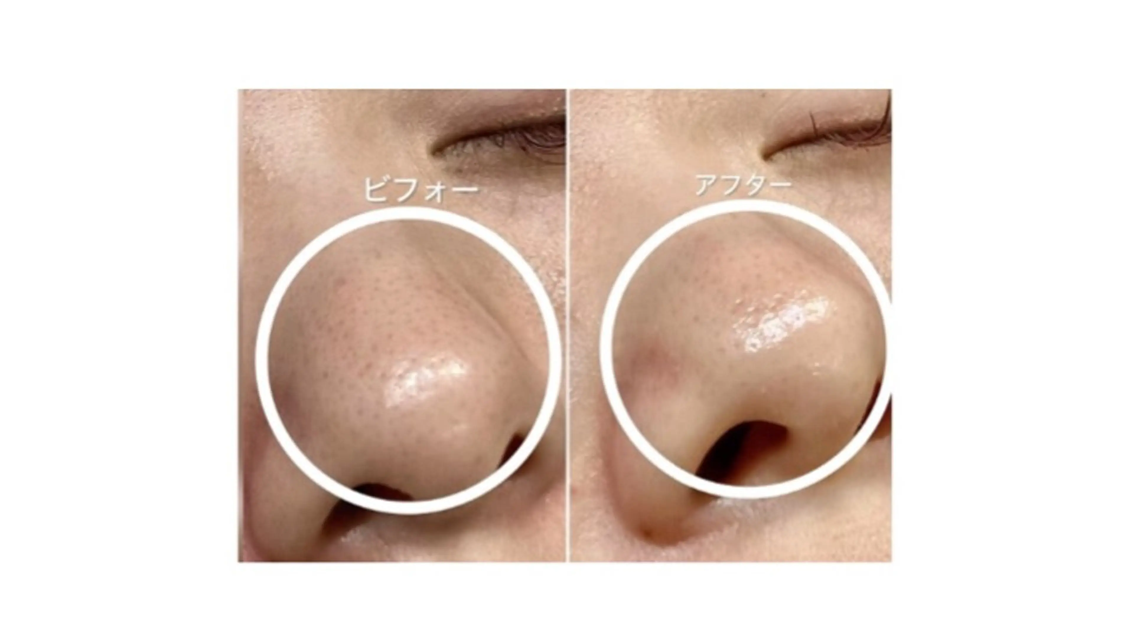 24日限定⭐️【お顔まるごと脱毛】フェイシャルワックスの写真